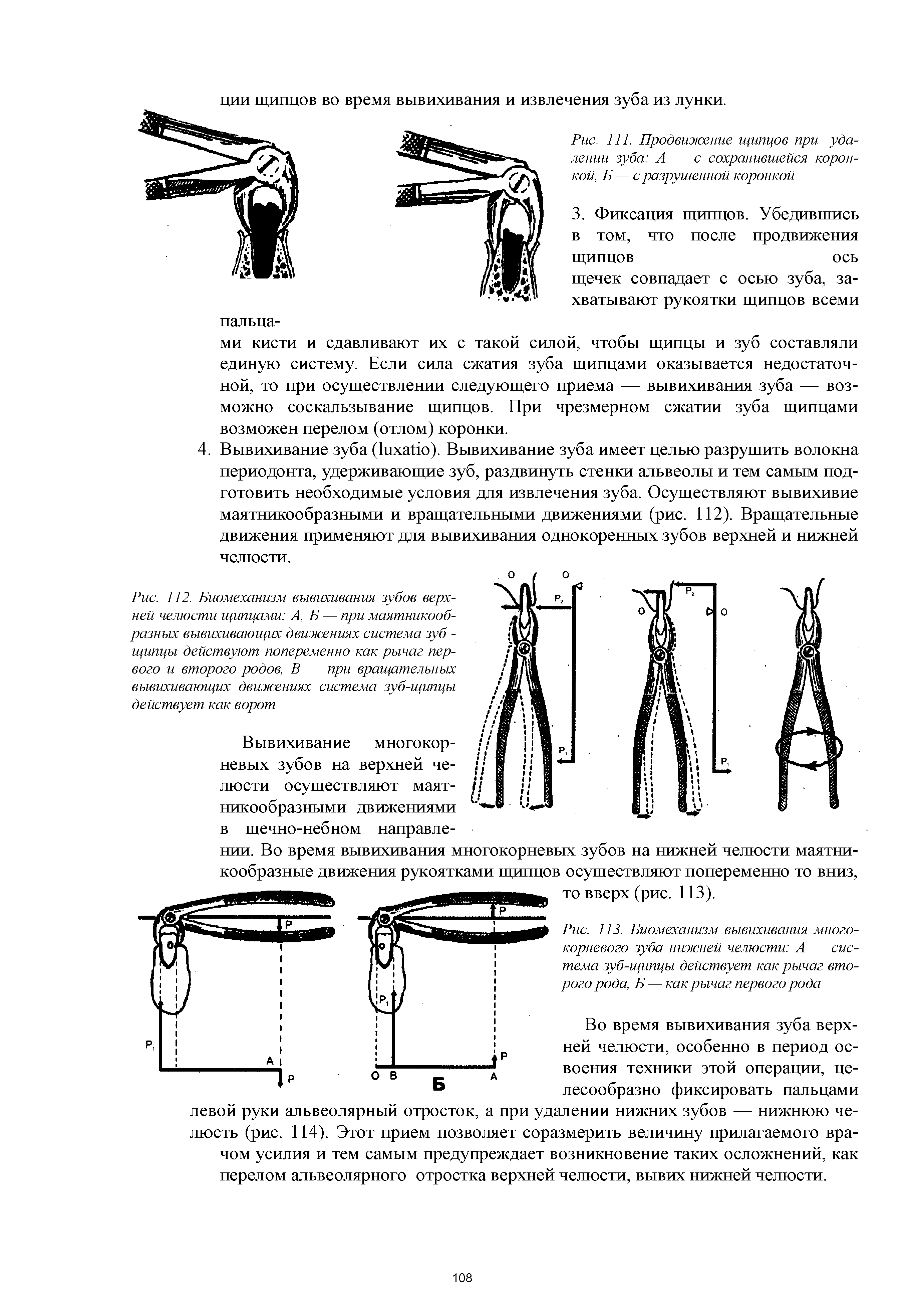 Рис. 111. Продвижение щипцов при удалении зуба А — с сохранившейся коронкой, Б— с разрушенной коронкой...