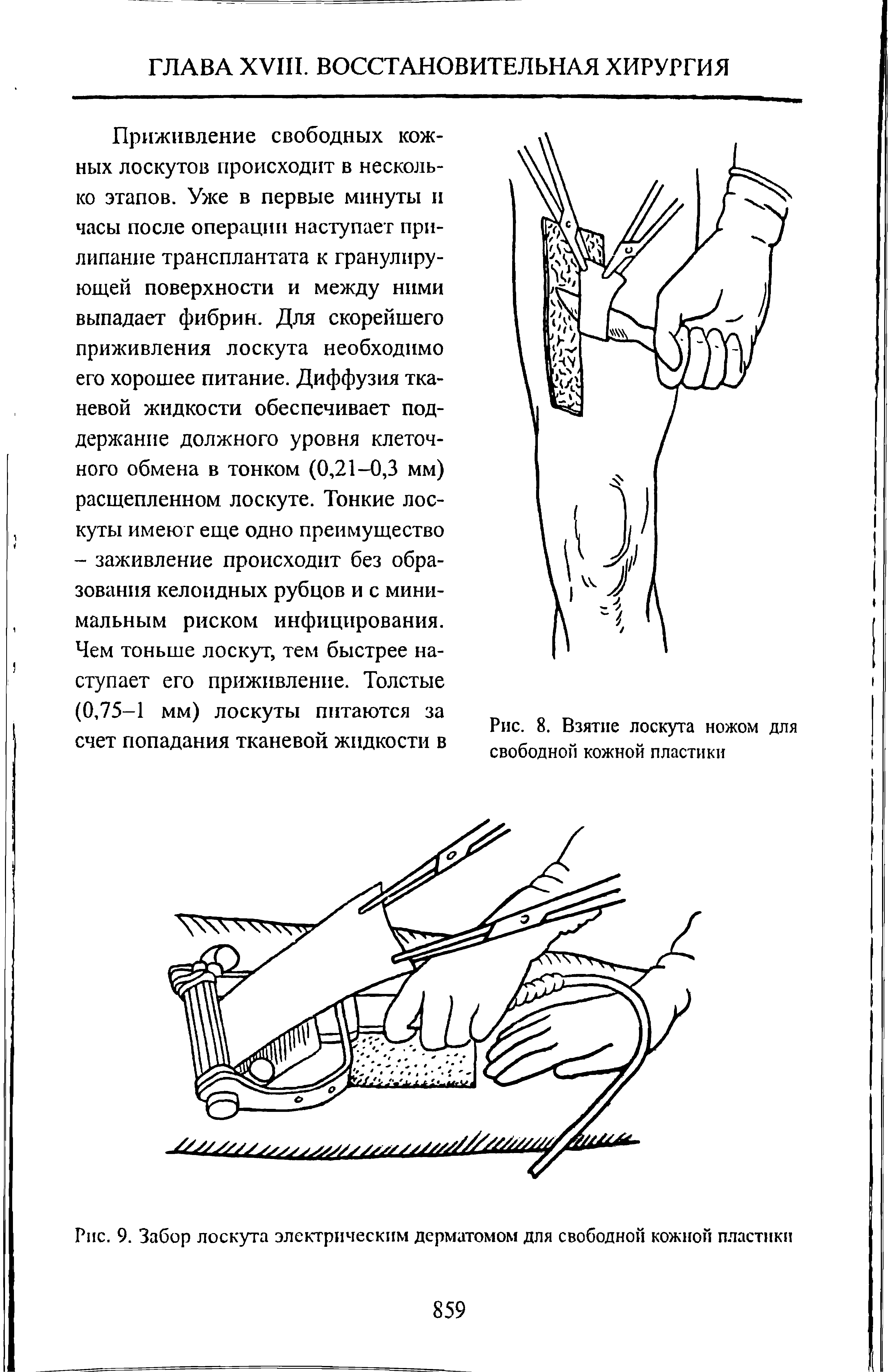 Рис. 9. Забор лоскута электрическим дерматомом для свободной кожной пластики...