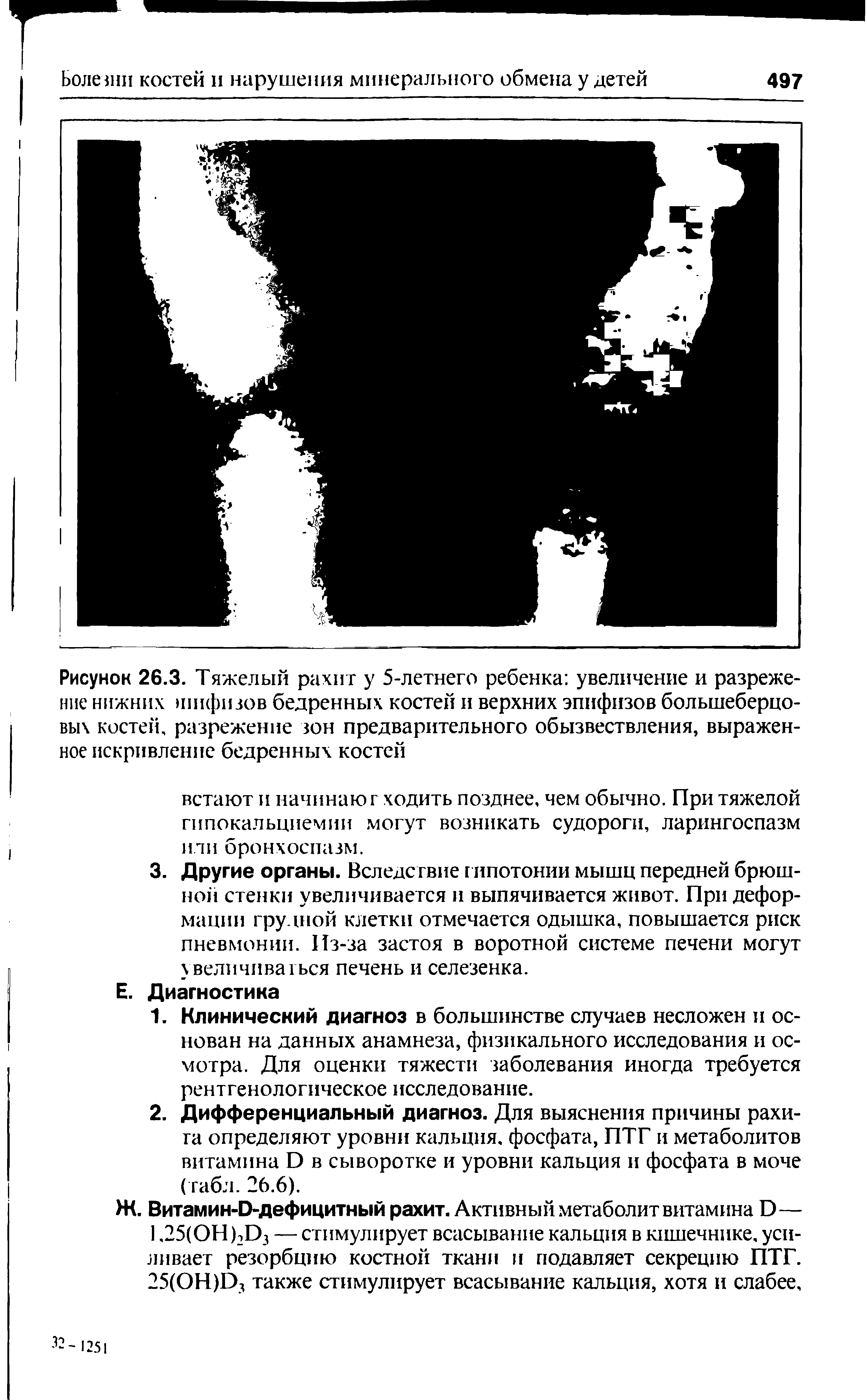 Рисунок 26.3. Тяжелый рахит у 5-летнего ребенка увеличение и разрежение нижних шифизов бедренных костей и верхних эпифизов большеберцовых костей, разрежение зон предварительного обызвествления, выраженное искривление бедренных костей...