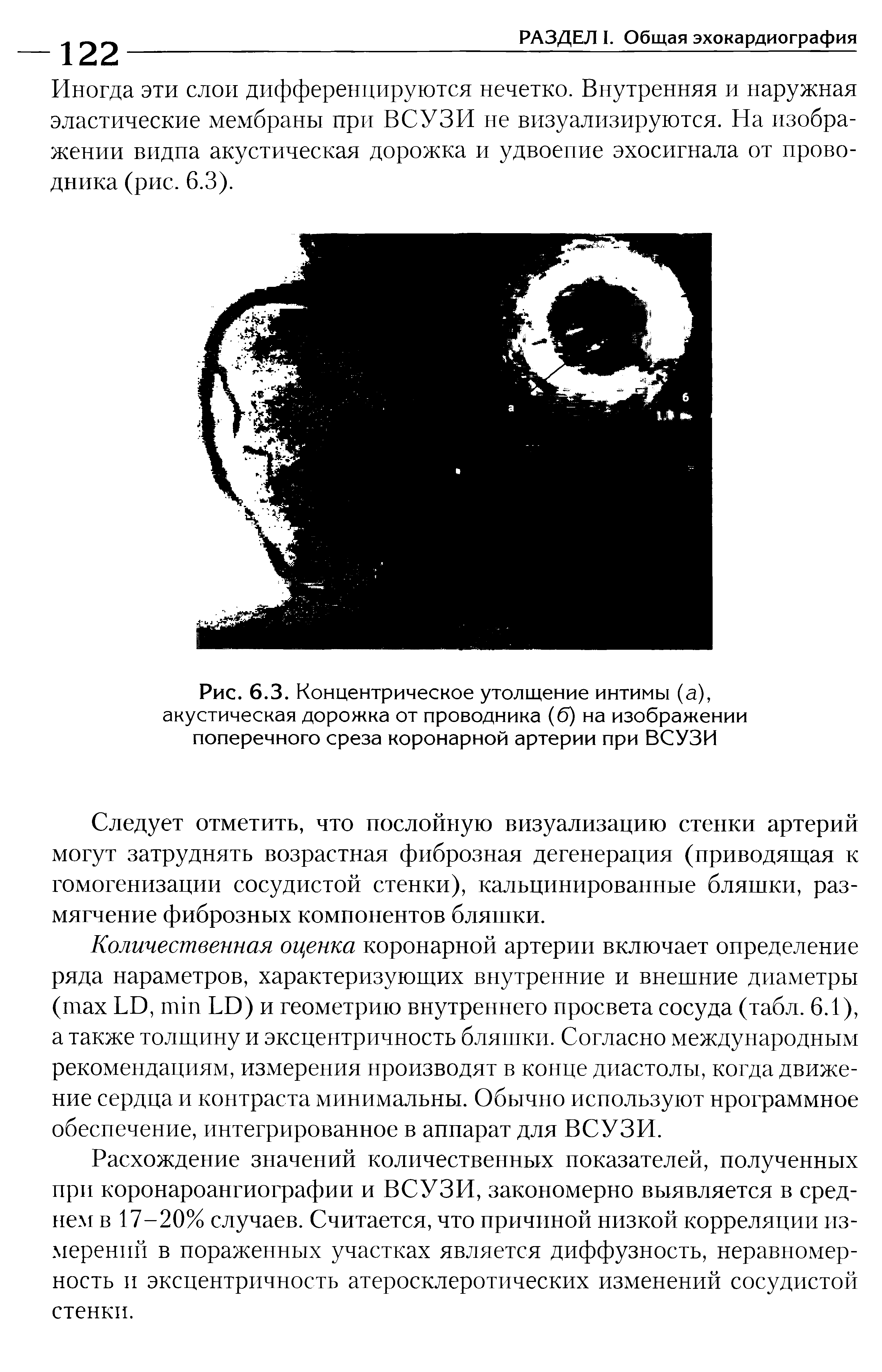 Рис. 6.3. Концентрическое утолщение интимы (а), акустическая дорожка от проводника (6) на изображении поперечного среза коронарной артерии при ВСУЗИ...