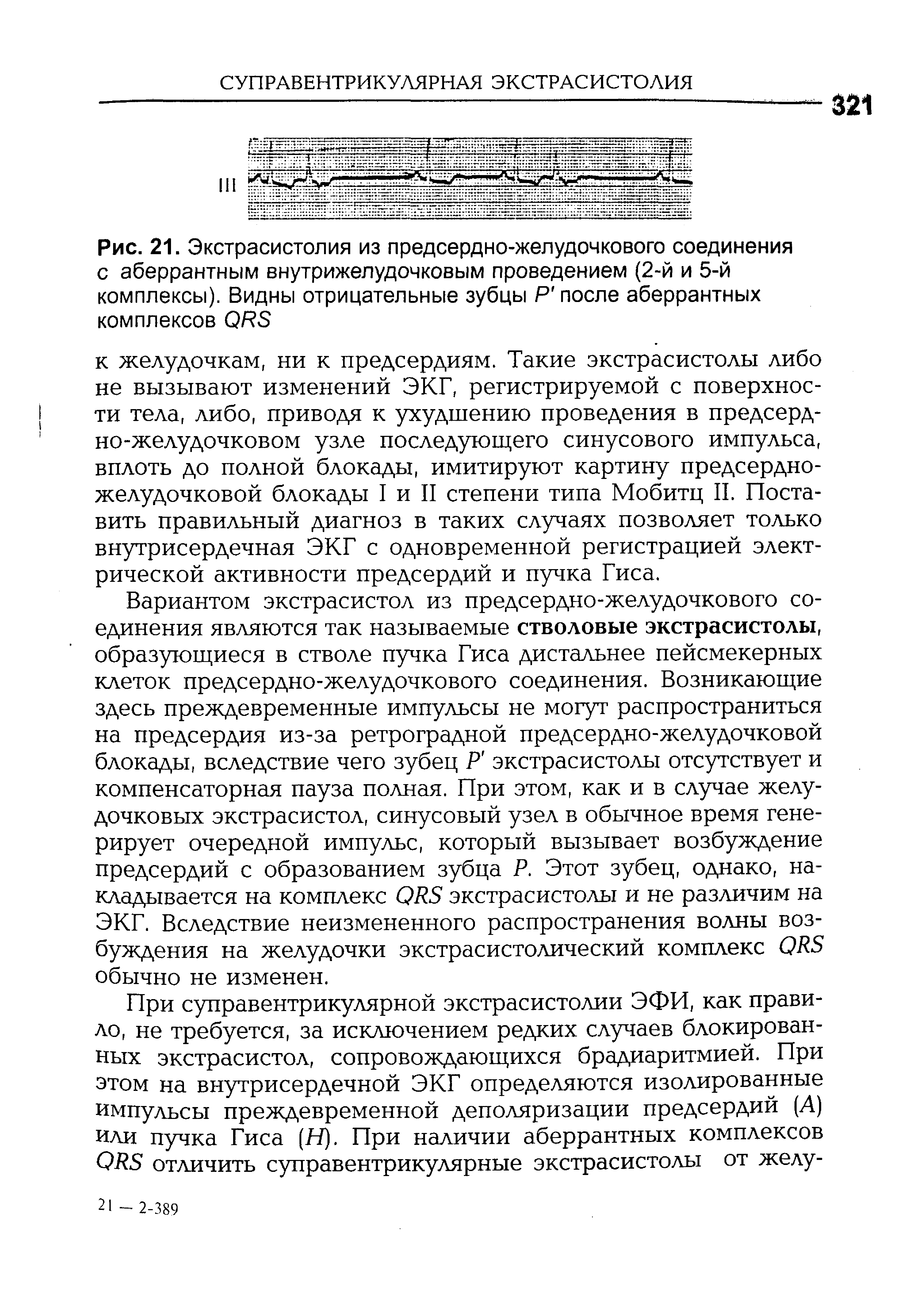 Рис. 21. Экстрасистолия из предсердно-желудочкового соединения с аберрантным внутрижелудочковым проведением (2-й и 5-й комплексы). Видны отрицательные зубцы Р после аберрантных комплексов QRS...