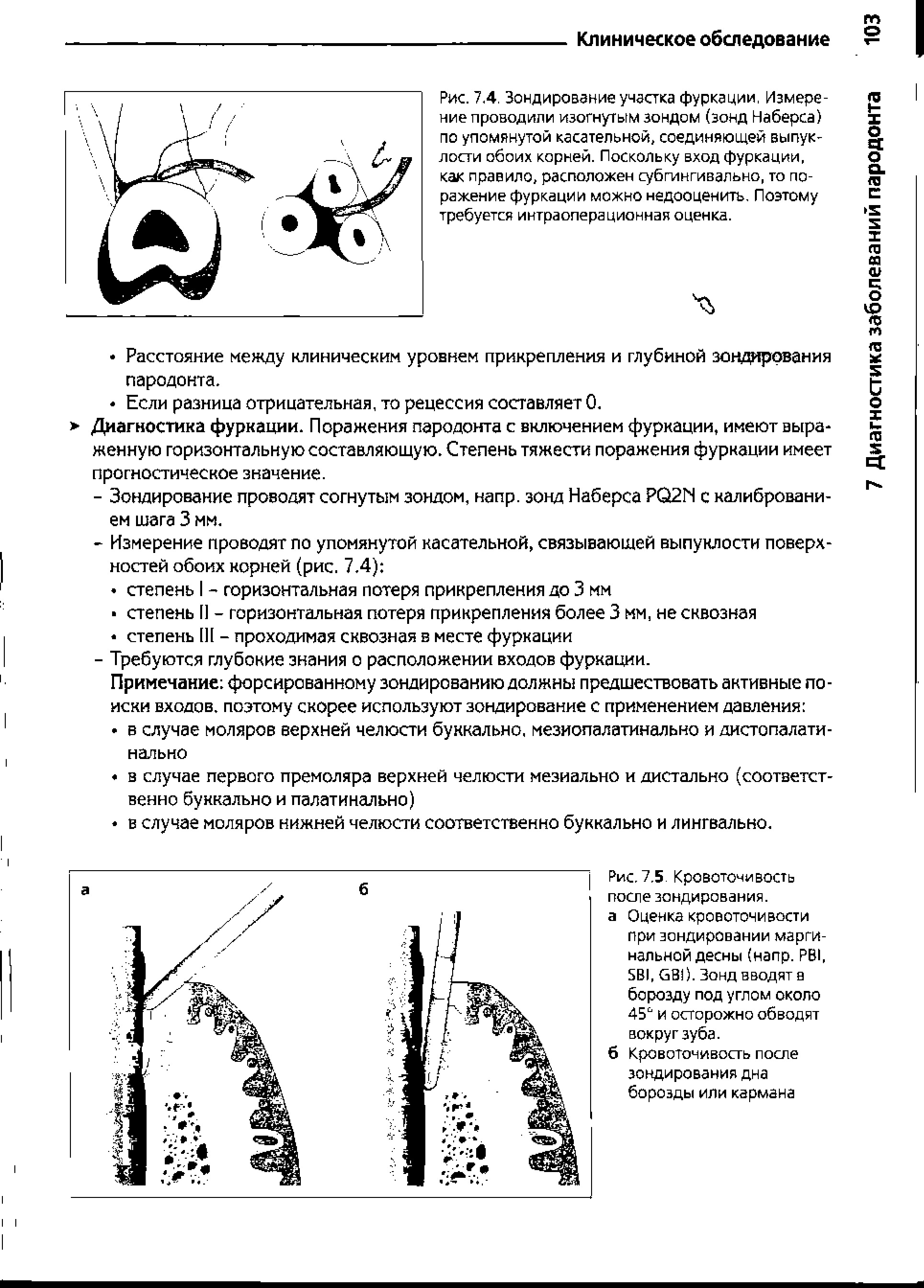 Рис. 7.4. Зондирование участка фуркации, Измере ние проводили изогнутым зондом (зонд Наберса) по упомянутой касательной, соединяющей выпуклости обоих корней. Поскольку вход фуркации, как правило, расположен субгингивально, то поражение фуркации можно недооценить. Поэтому требуется интраоперационная оценка.