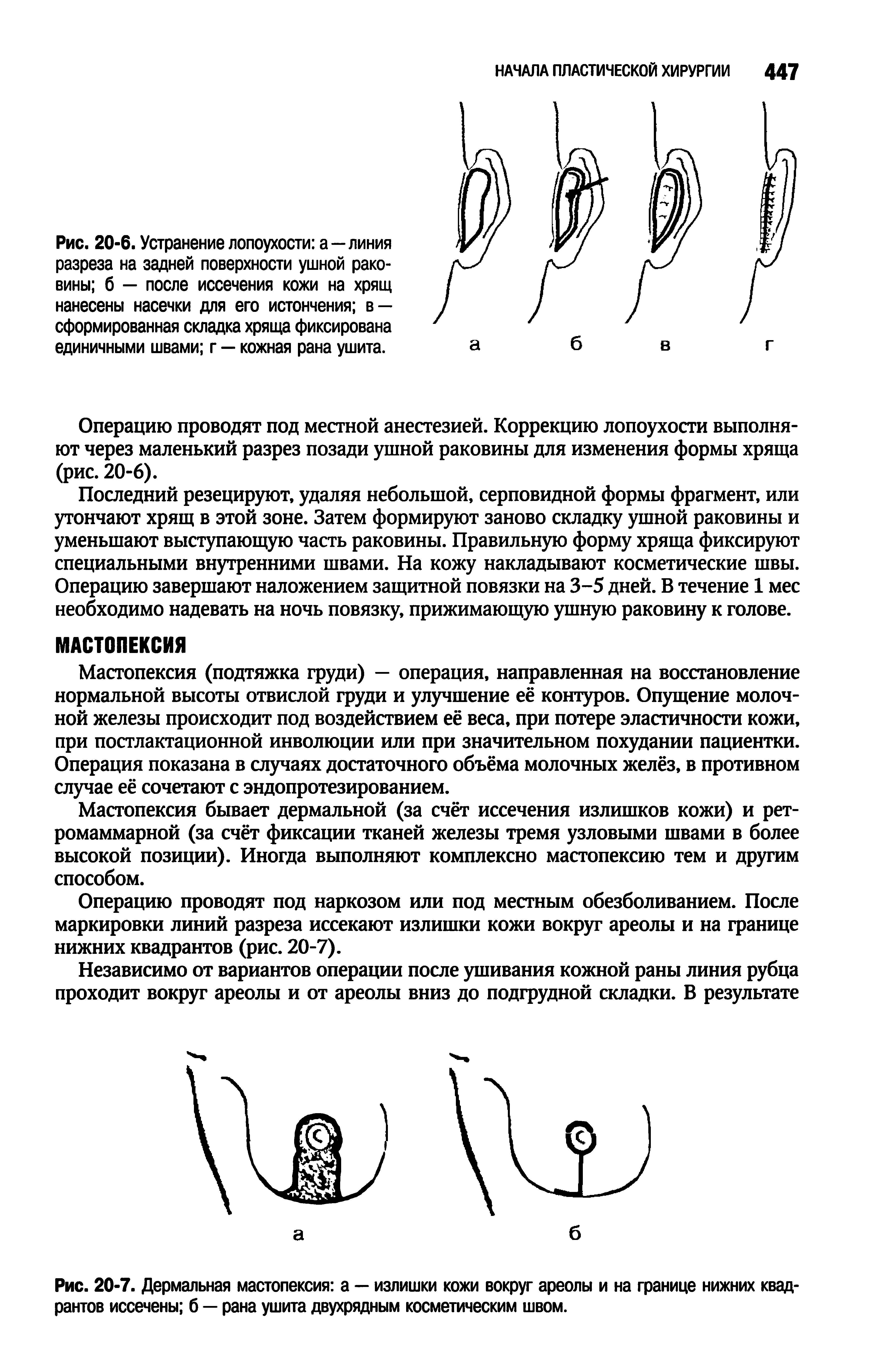 Рис. 20-7. Дермальная мастопексия а — излишки кожи вокруг ареолы и на границе нижних квад рантов иссечены б — рана ушита двухрядным косметическим швом.
