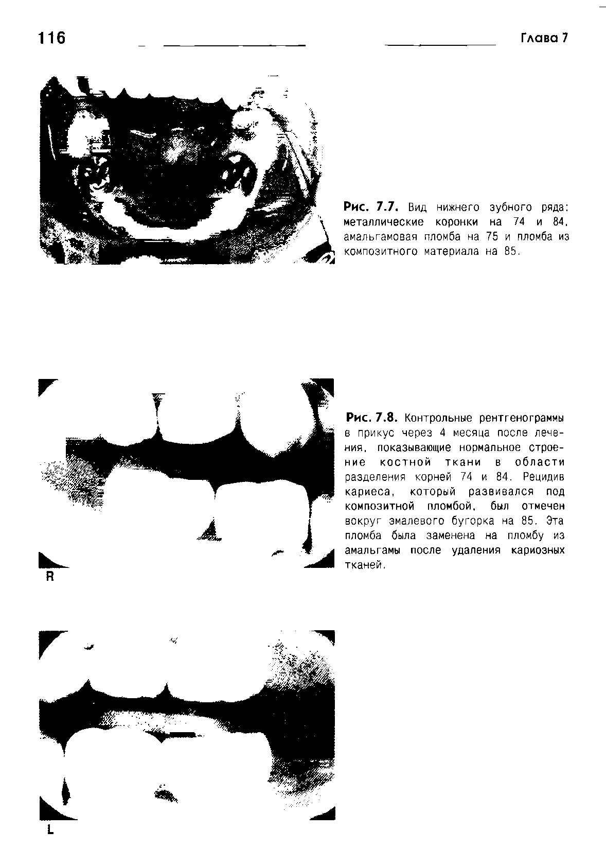 Рис. 7.8. Контрольные рентгенограммы в прикус через 4 месяца после лечения, показывающие нормальное строение костной ткани в области разделения корней 74 и 84. Рецидив кариеса, который развивался под композитной пломбой, был отмечен вокруг эмалевого бугорка на 85. Эта пломба была заменена на пломбу из амальгамы после удаления кариозных тканей.