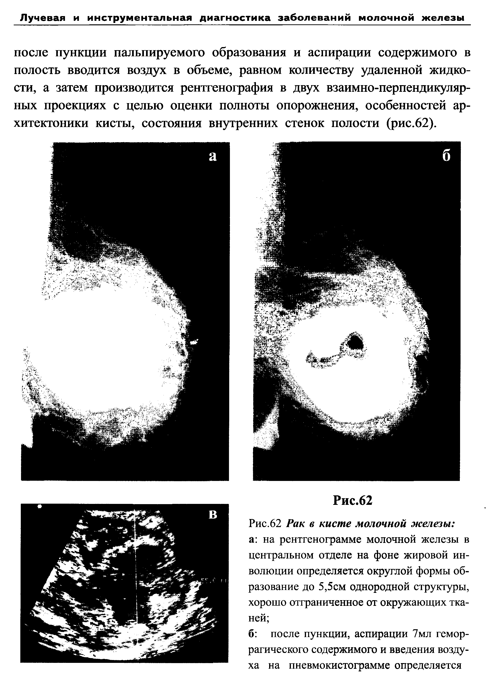 Рис.62 Рак в кисте молочной железы а на рентгенограмме молочной железы в центральном отделе на фоне жировой инволюции определяется округлой формы образование до 5,5см однородной структуры, хорошо отграниченное от окружающих тканей ...