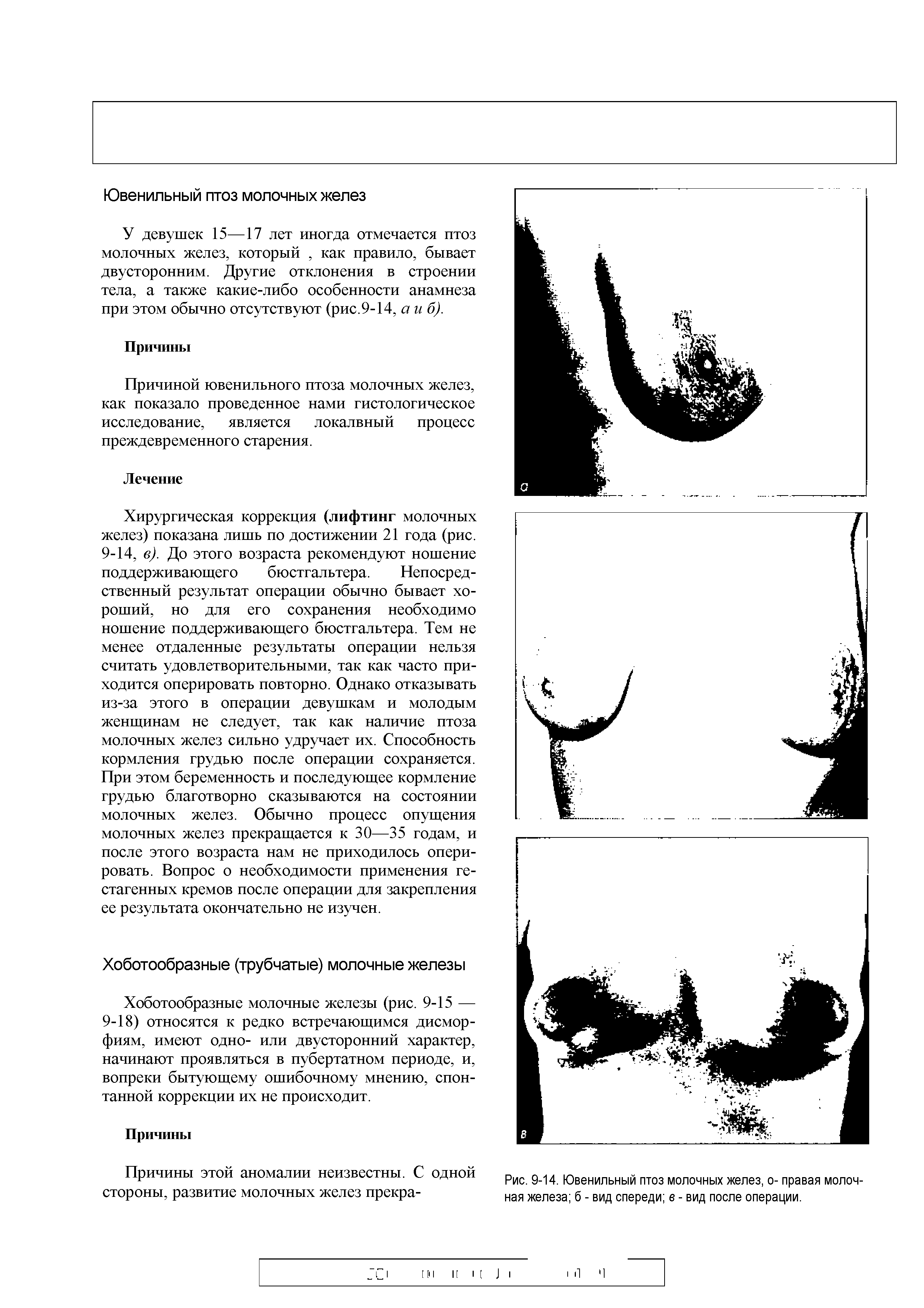 Рис. 9-14. Ювенильный птоз молочных желез, о- правая молочная железа б - вид спереди в - вид после операции.
