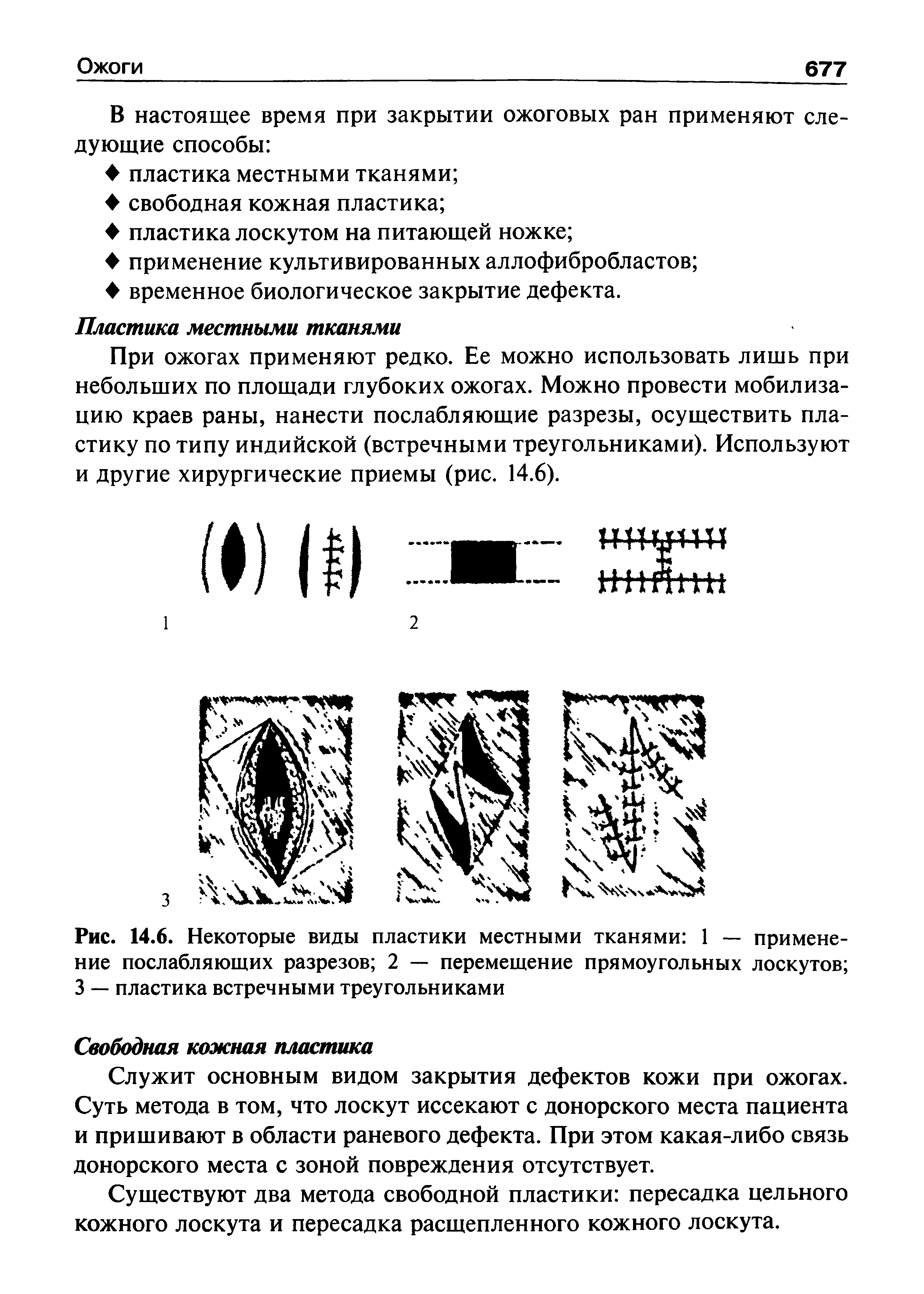 Рис. 14.6. Некоторые виды пластики местными тканями 1 — применение послабляющих разрезов 2 — перемещение прямоугольных лоскутов 3 — пластика встречными треугольниками...