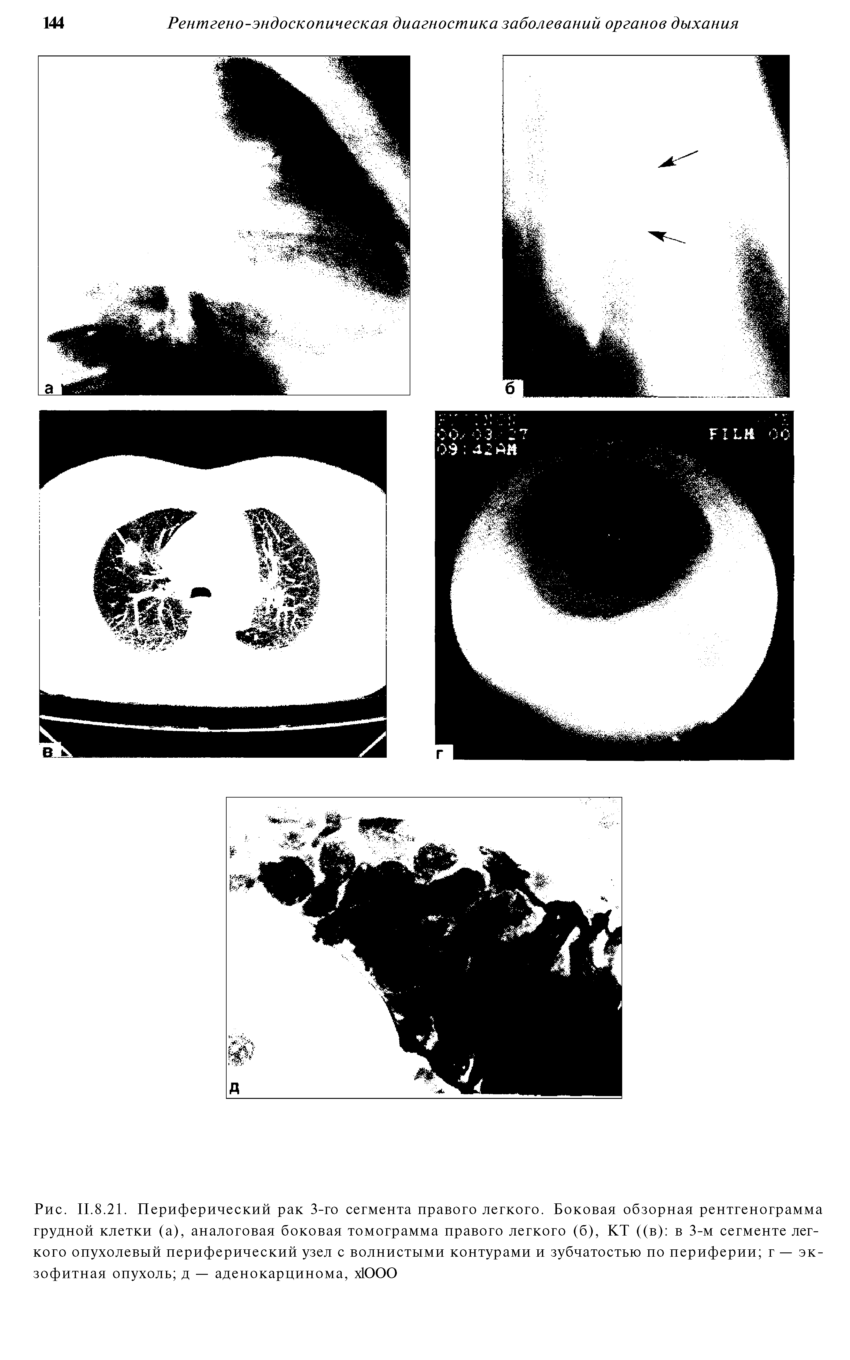 Рис. II.8.21. Периферический рак 3-го сегмента правого легкого. Боковая обзорная рентгенограмма грудной клетки (а), аналоговая боковая томограмма правого легкого (б), КТ ((в) в 3-м сегменте легкого опухолевый периферический узел с волнистыми контурами и зубчатостью по периферии г — экзофитная опухоль д — аденокарцинома, х1000...