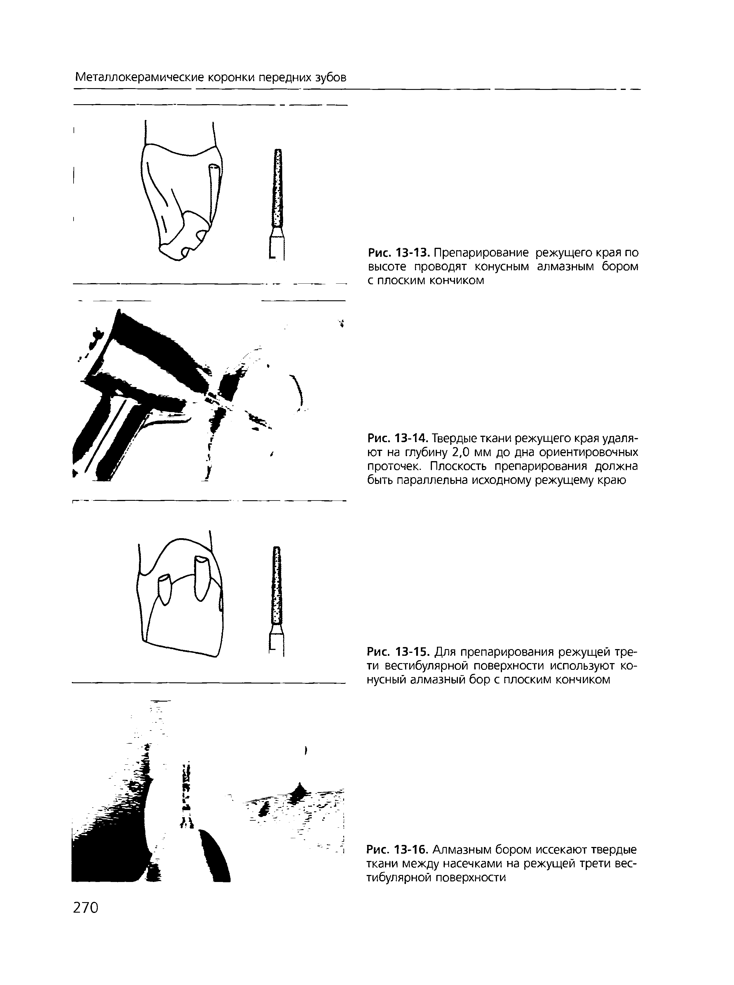 Рис. 13-14. Твердые ткани режущего края удаляют на глубину 2,0 мм до дна ориентировочных проточек. Плоскость препарирования должна быть параллельна исходному режущему краю...