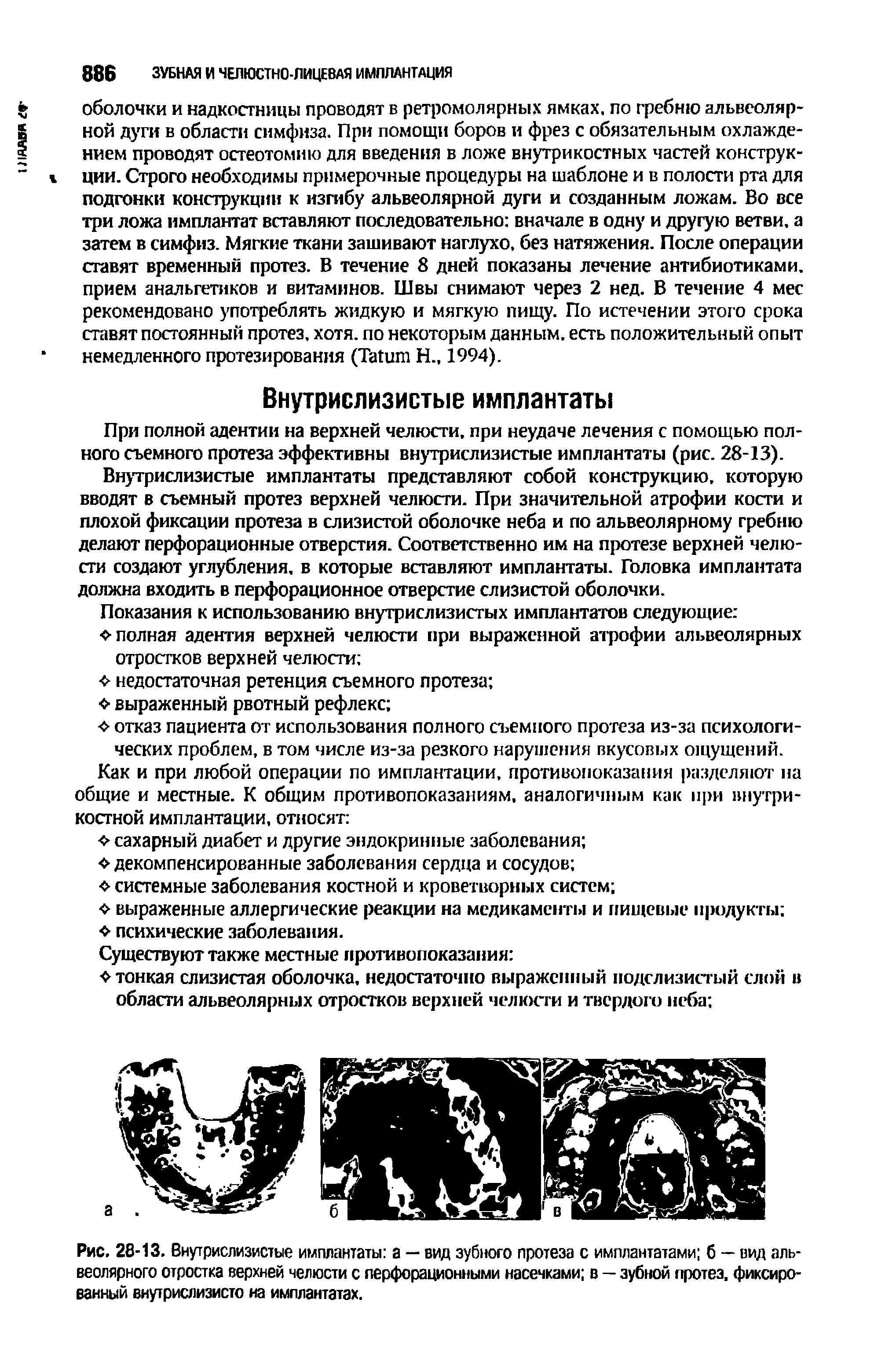 Рис. 28-13. Внутрислизистые имплантаты а — вид зубного протеза с имплантатами б — вид альвеолярного отростка верхней челюсти с перфорационными насечками в — зубной протез, фиксированный внутрислизисто на имплантатах.