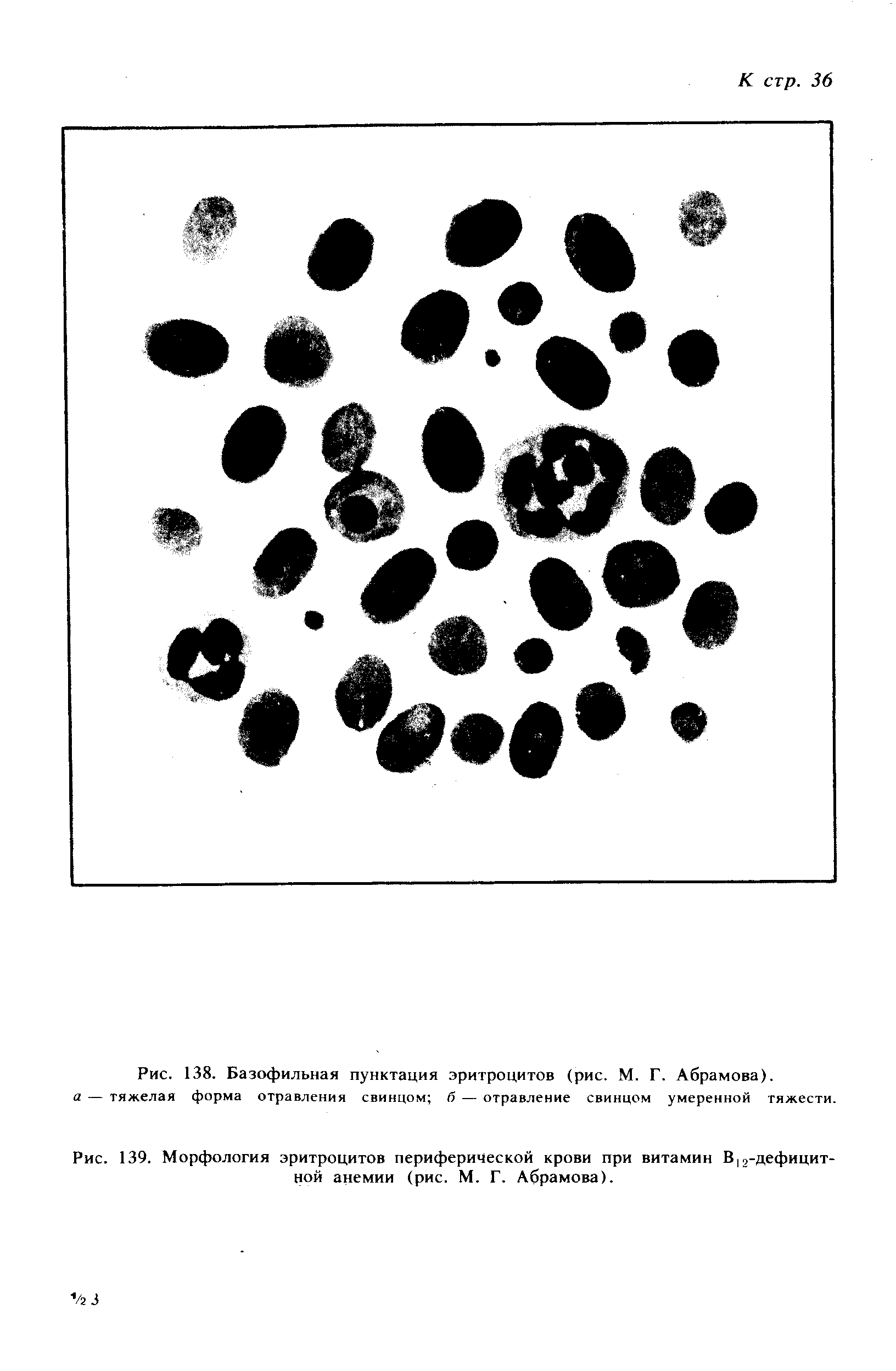 Рис. 138. Базофильная пунктация эритроцитов (рис. М. Г. Абрамова). а — тяжелая форма отравления свинцом б — отравление свинцом умеренной тяжести.