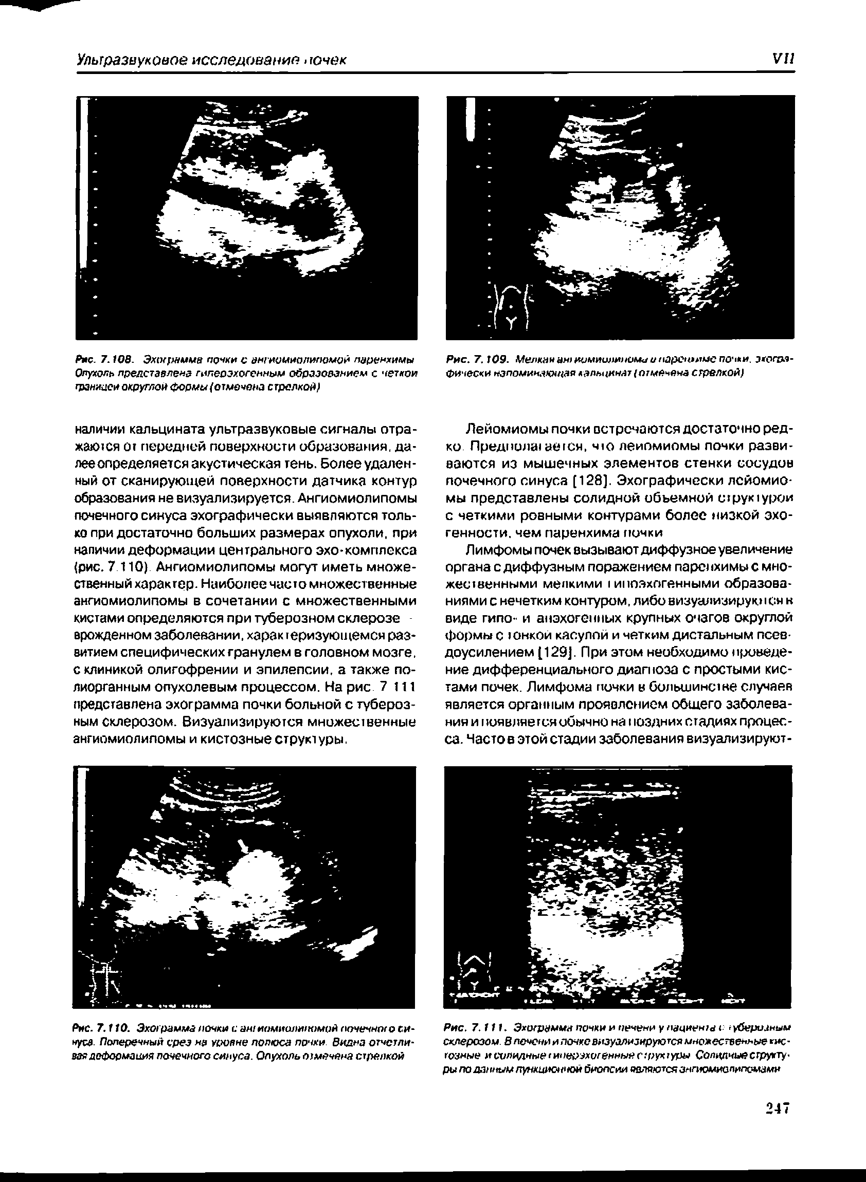 Рис. 7. Т ТО. Эхограмма ночки с антиомиалипомой почечною синуса- Поперечный срез на уровне полюса почки Видна отчетливая деформация почечного синуса. Опухоль отмечена стрелкой...