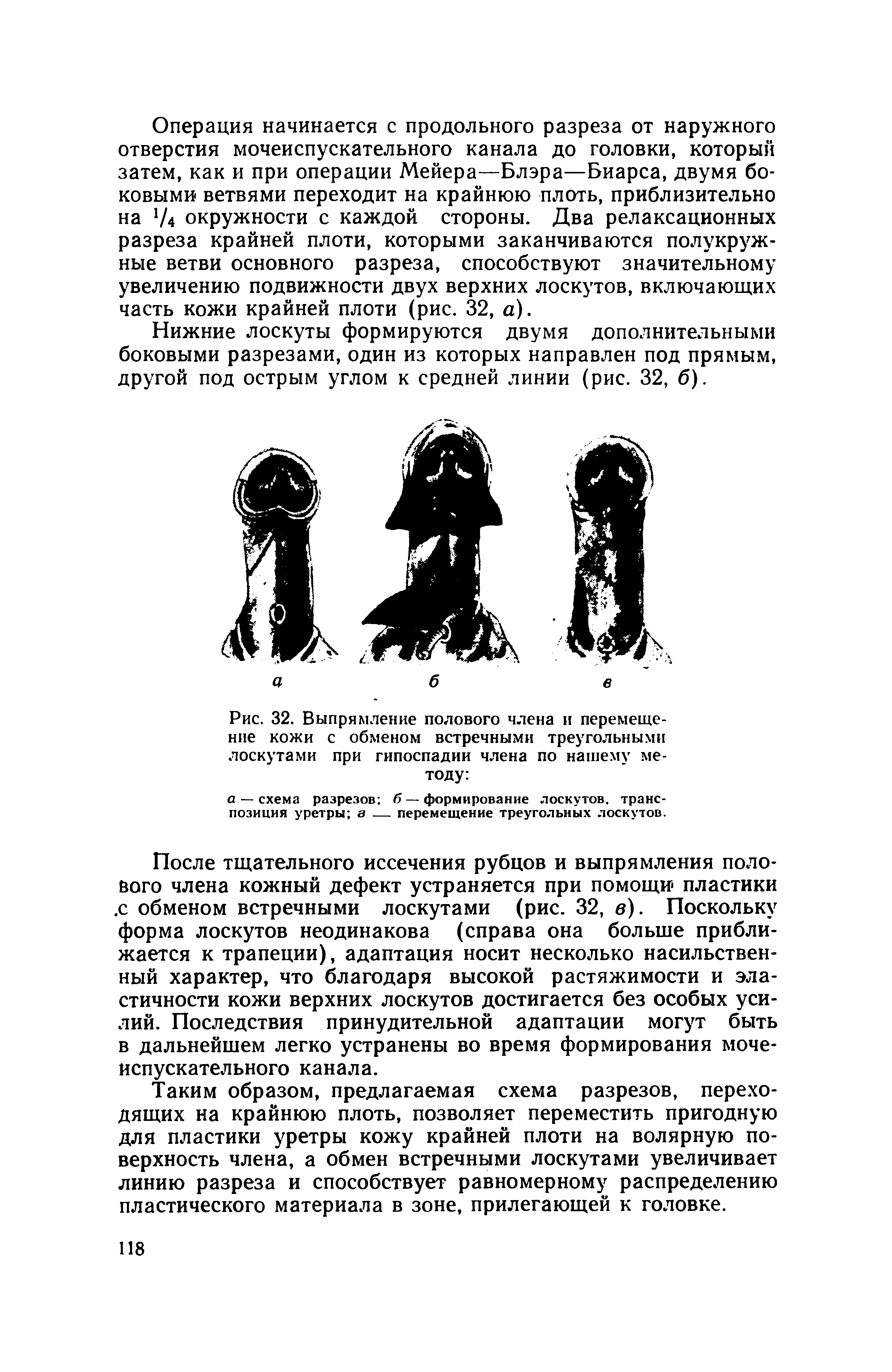 Рис. 32. Выпрямление полового члена и перемещение кожи с обменом встречными треугольными лоскутами при гипоспадии члена по нашему методу ...