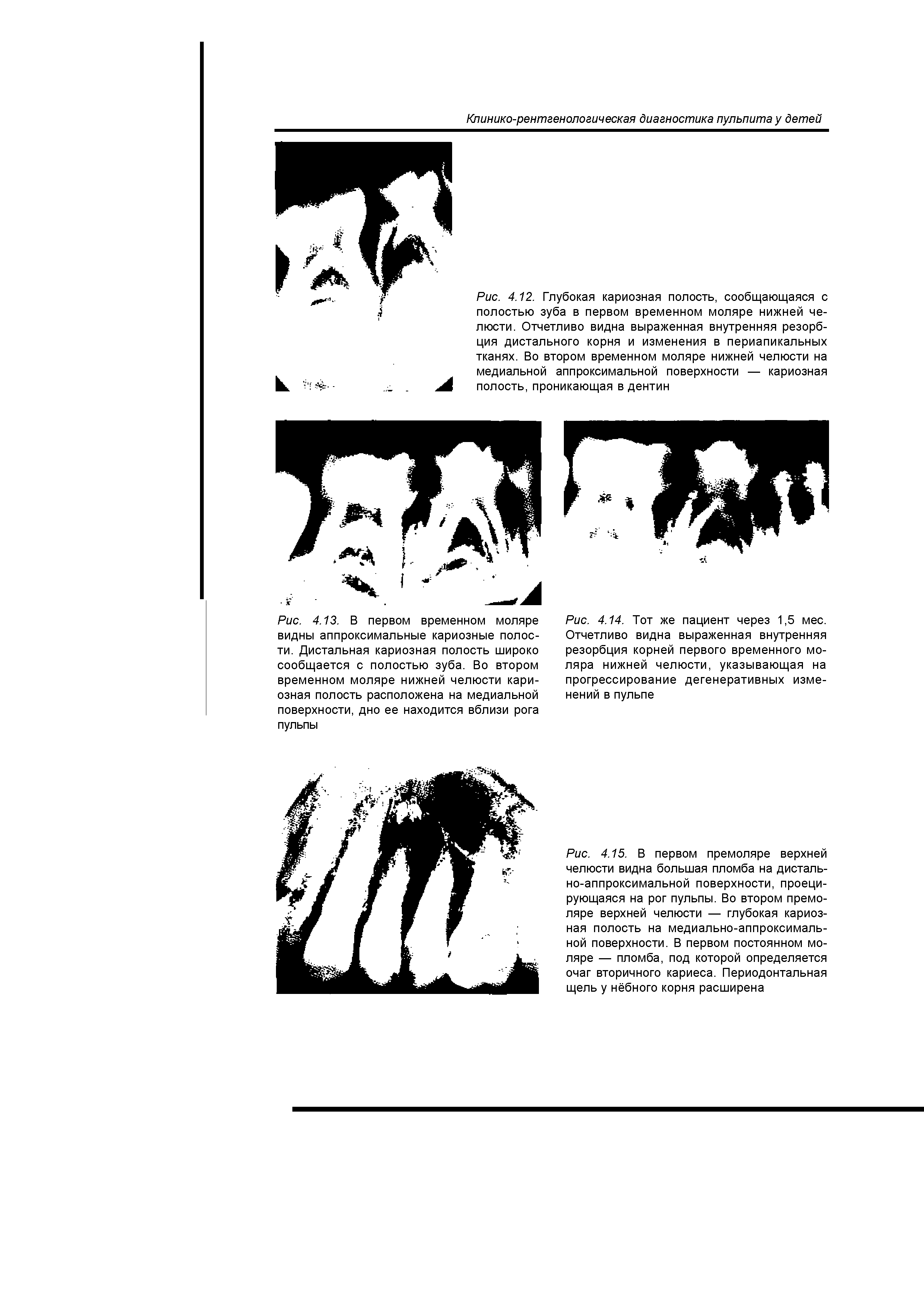 Рис. 4.14. Тот же пациент через 1,5 мес. Отчетливо видна выраженная внутренняя резорбция корней первого временного моляра нижней челюсти, указывающая на прогрессирование дегенеративных изменений в пульпе...