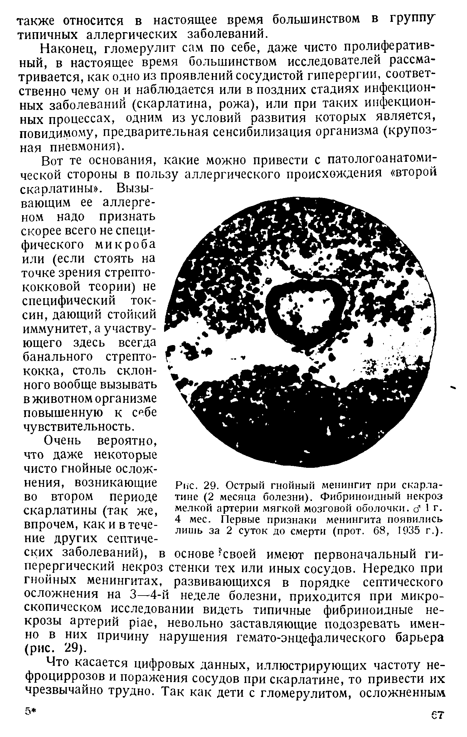 Рис. 29. Острый гнойный менингит при скарлатине (2 месяца болезни). Фибриноидный некроз мелкой артерии мягкой мозговой оболочки, с 1 г. 4 мес. Первые признаки менингита появились лишь за 2 суток до смерти (прот. 68, 1935 г.), основе своей имеют первоначальный гн-...