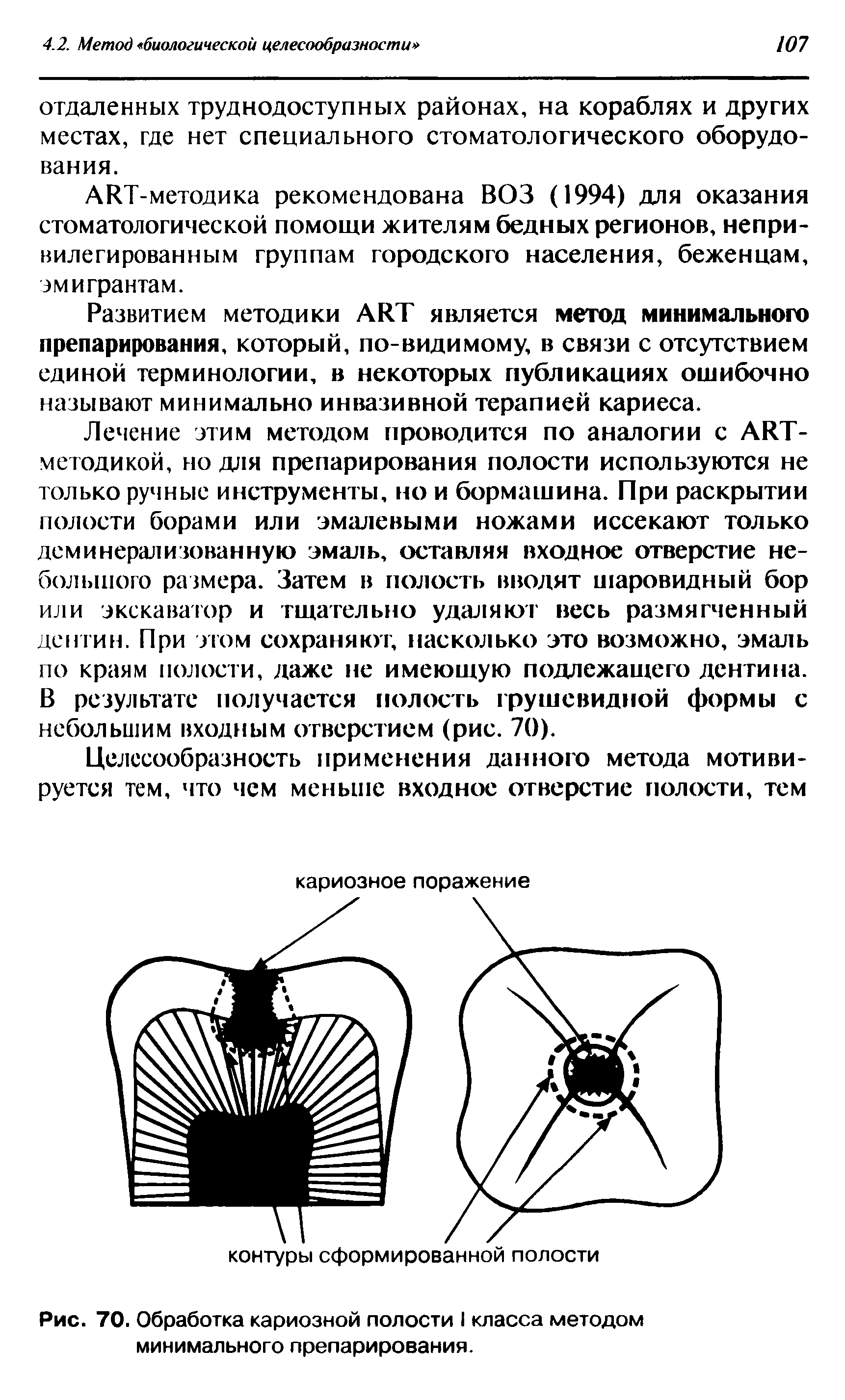 Рис. 70. Обработка кариозной полости I класса методом минимального препарирования.