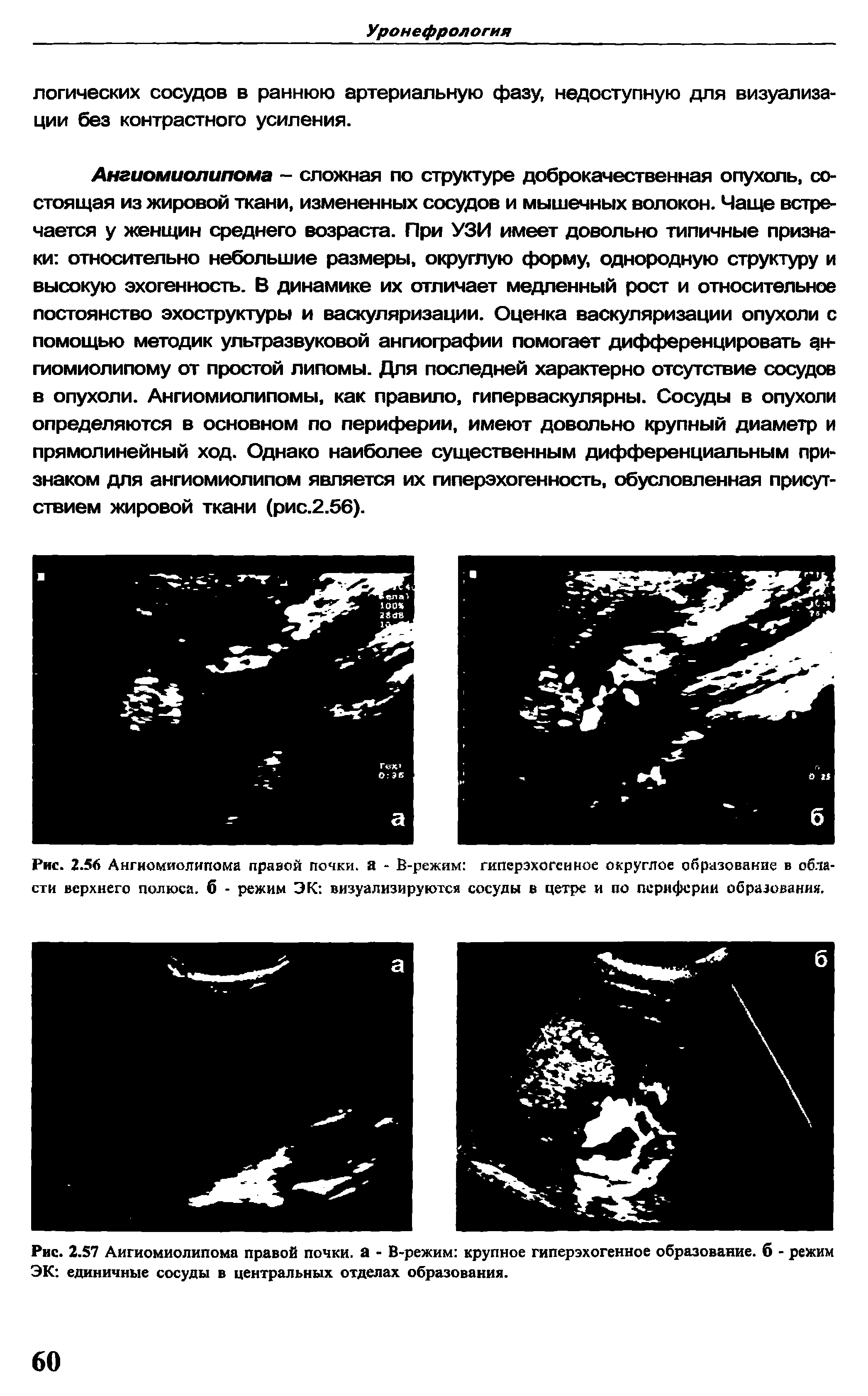 Рис. 2.56 Ангиомиолипома правой почки, а - Ё-режим гиперэхогенное округлое образование в облй сти верхнего полюса, б - режим ЭК визуализируются сосуды в цетре и по периферии образования.