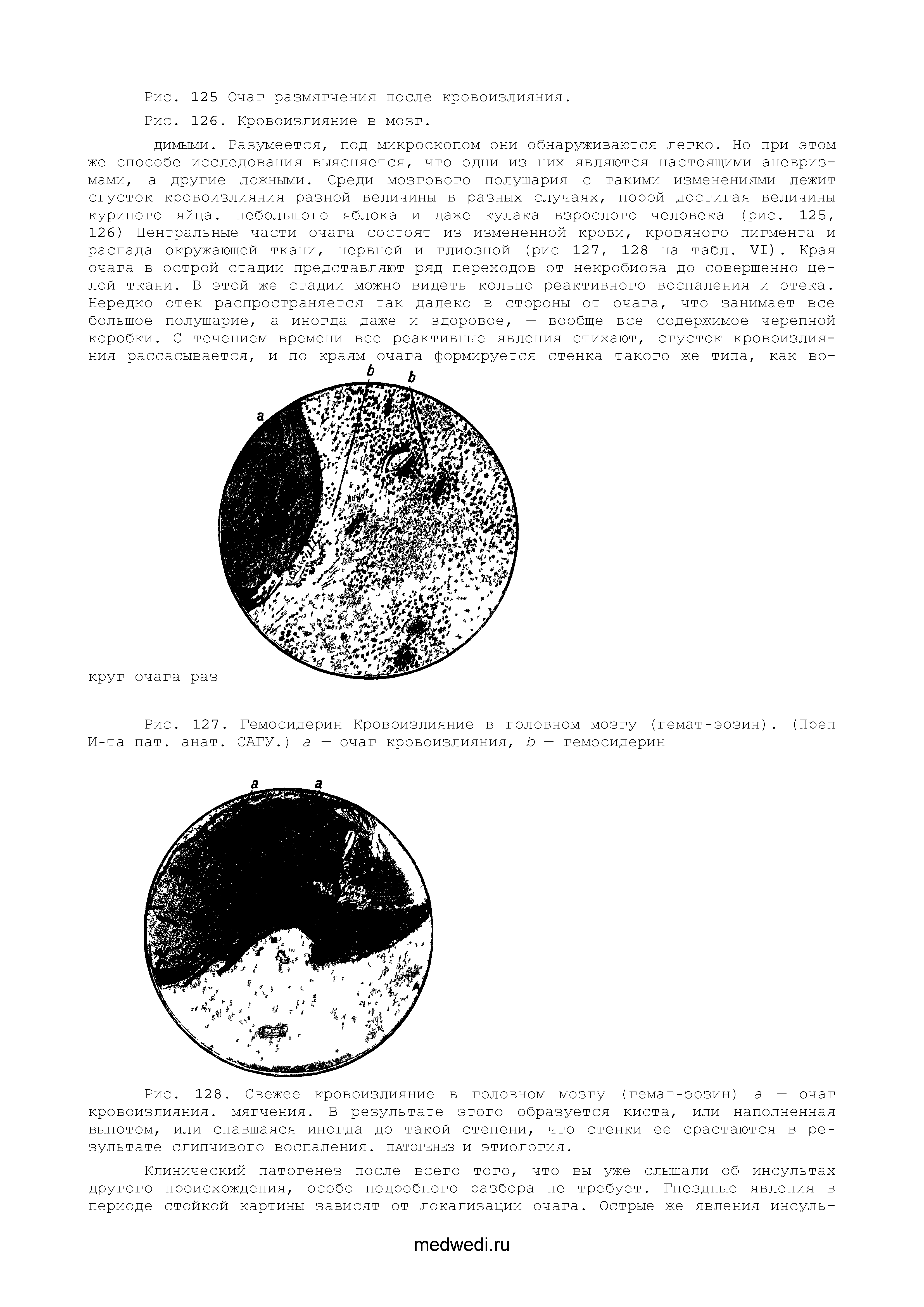 Рис. 128. Свежее кровоизлияние в головном мозгу (гемат-эозин) а — очаг кровоизлияния, мягчения. В результате этого образуется киста, или наполненная выпотом, или спавшаяся иногда до такой степени, что стенки ее срастаются в результате слипчивого воспаления, патогенез и этиология.