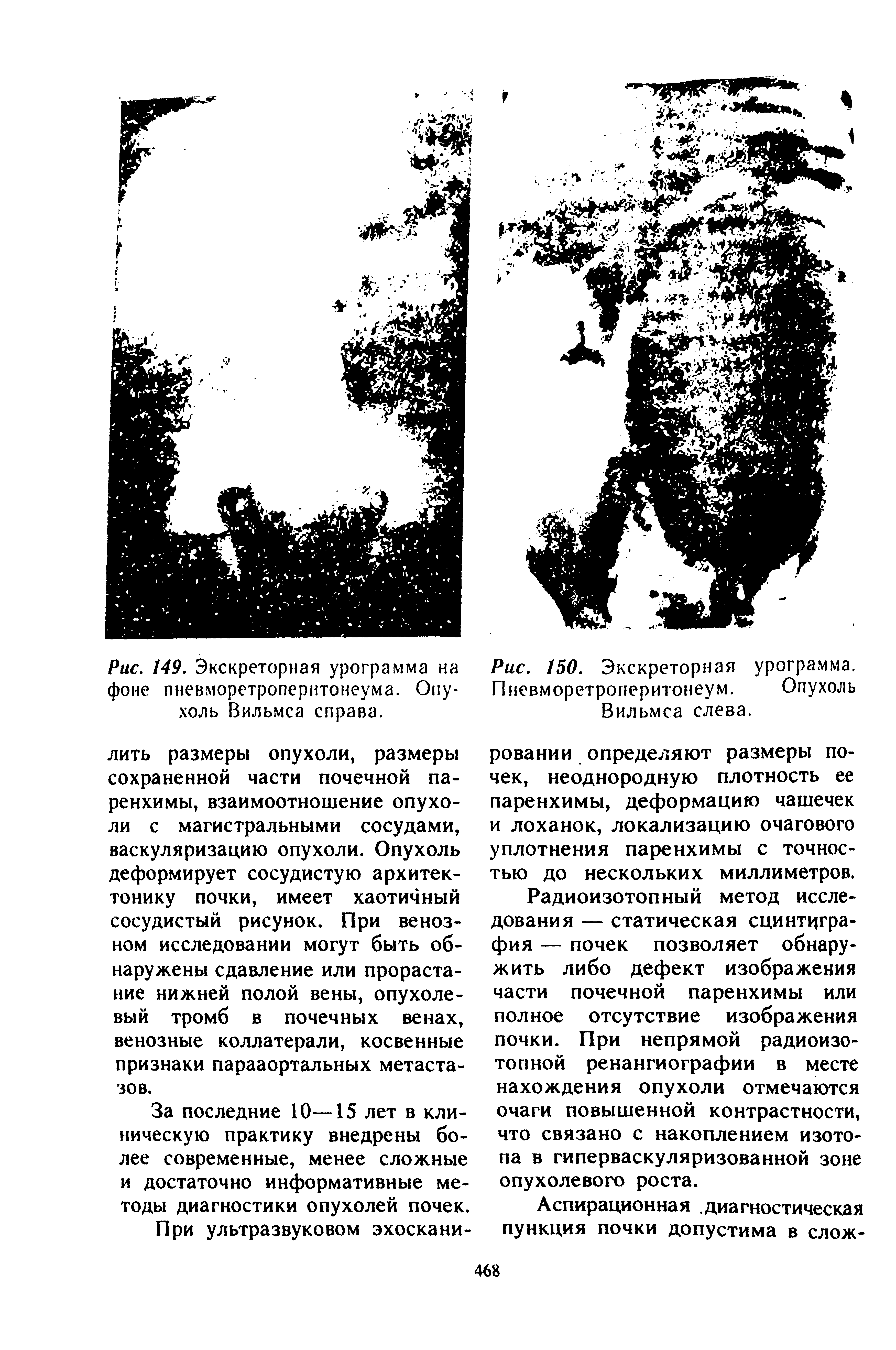 Рис. 150. Экскреторная урограмма. Пневморетроперитонеум. Опухоль Вильмса слева.