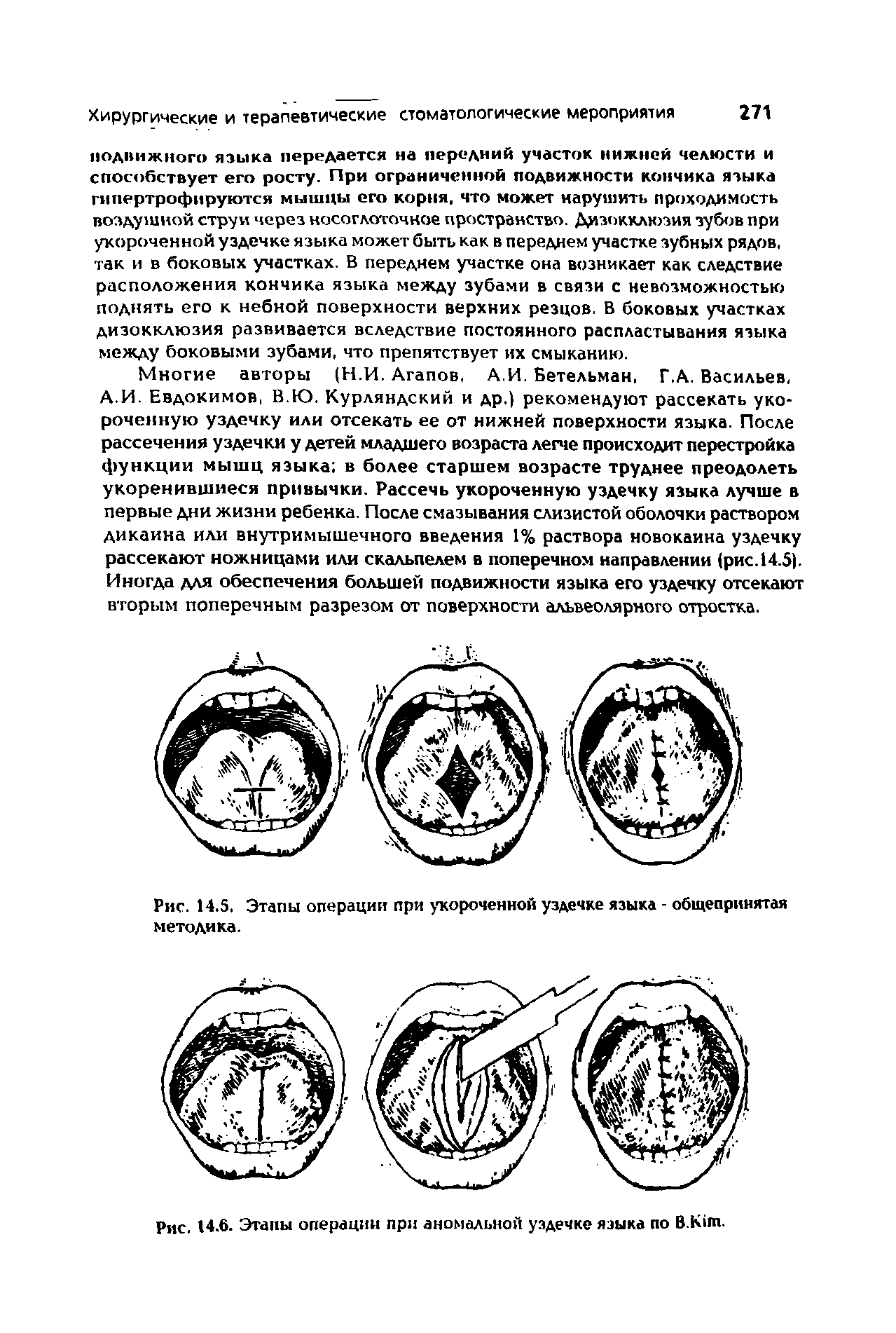 Рис. 14.5. Этапы операции при укороченной уздечке языка - общепринятая методика.