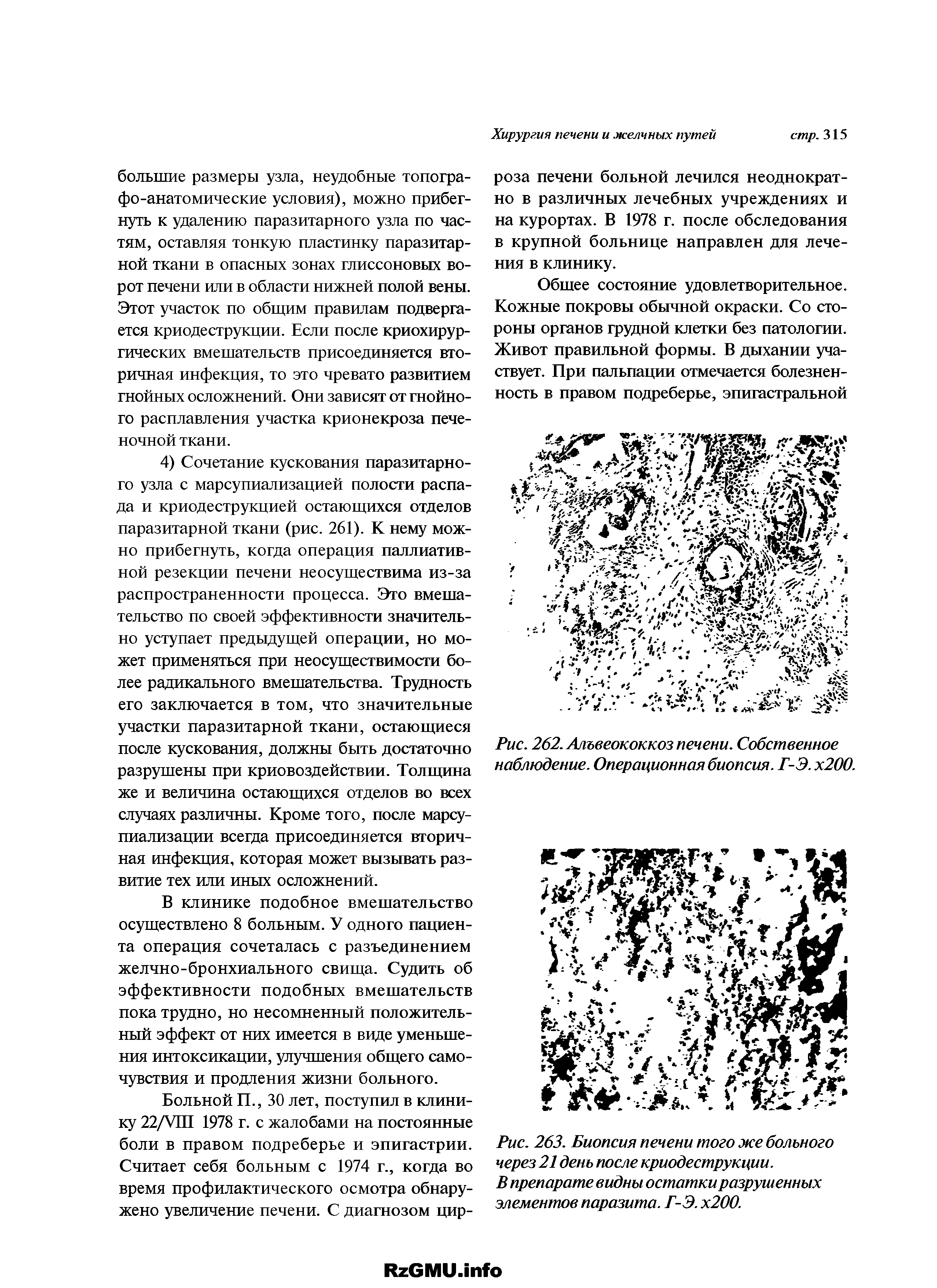 Рис. 262. Альвеококкоз печени. Собственное наблюдение. Операционная биопсия. Г-Э. х200.