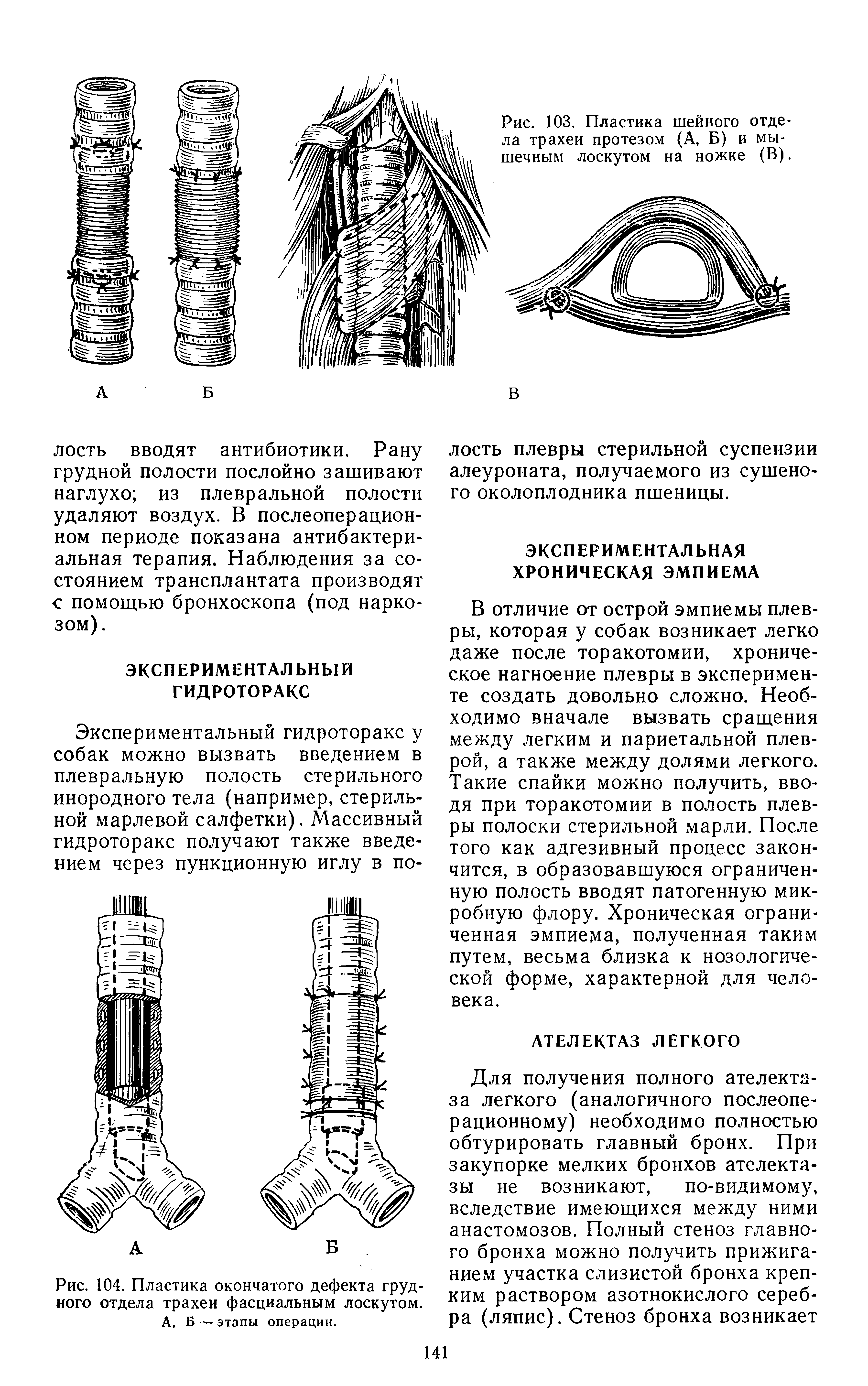 Рис. 103. Пластика шейного отдела трахеи протезом (А, Б) и мышечным лоскутом на ножке (В).