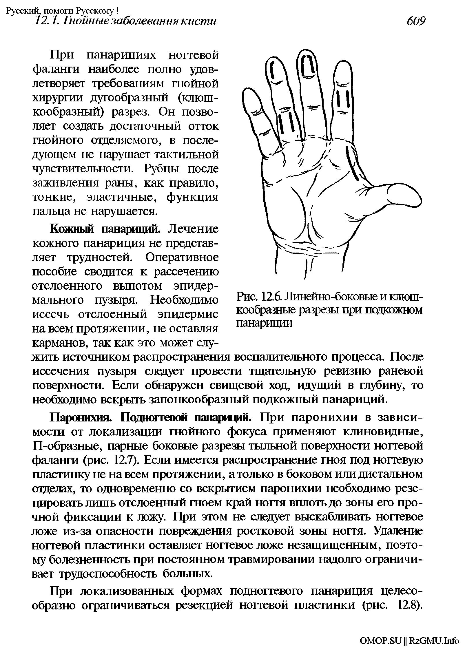 Рис. 12.6. Линейно-боковые и клюшкообразные разрезы при псдкожном панариции...