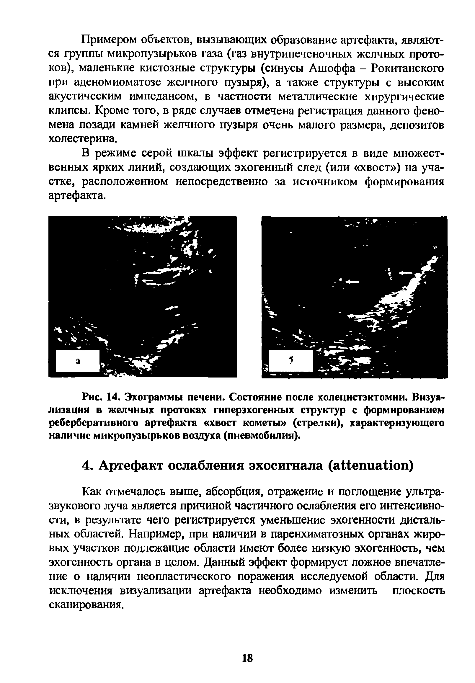 Рис. 14. Эхограммы печени. Состояние после холецистэктомии. Визуализация в желчных протоках гиперэхогенных структур с формированием реберберативного артефакта хвост кометы (стрелки), характеризующего наличие микропузырьков воздуха (пневмобилия).