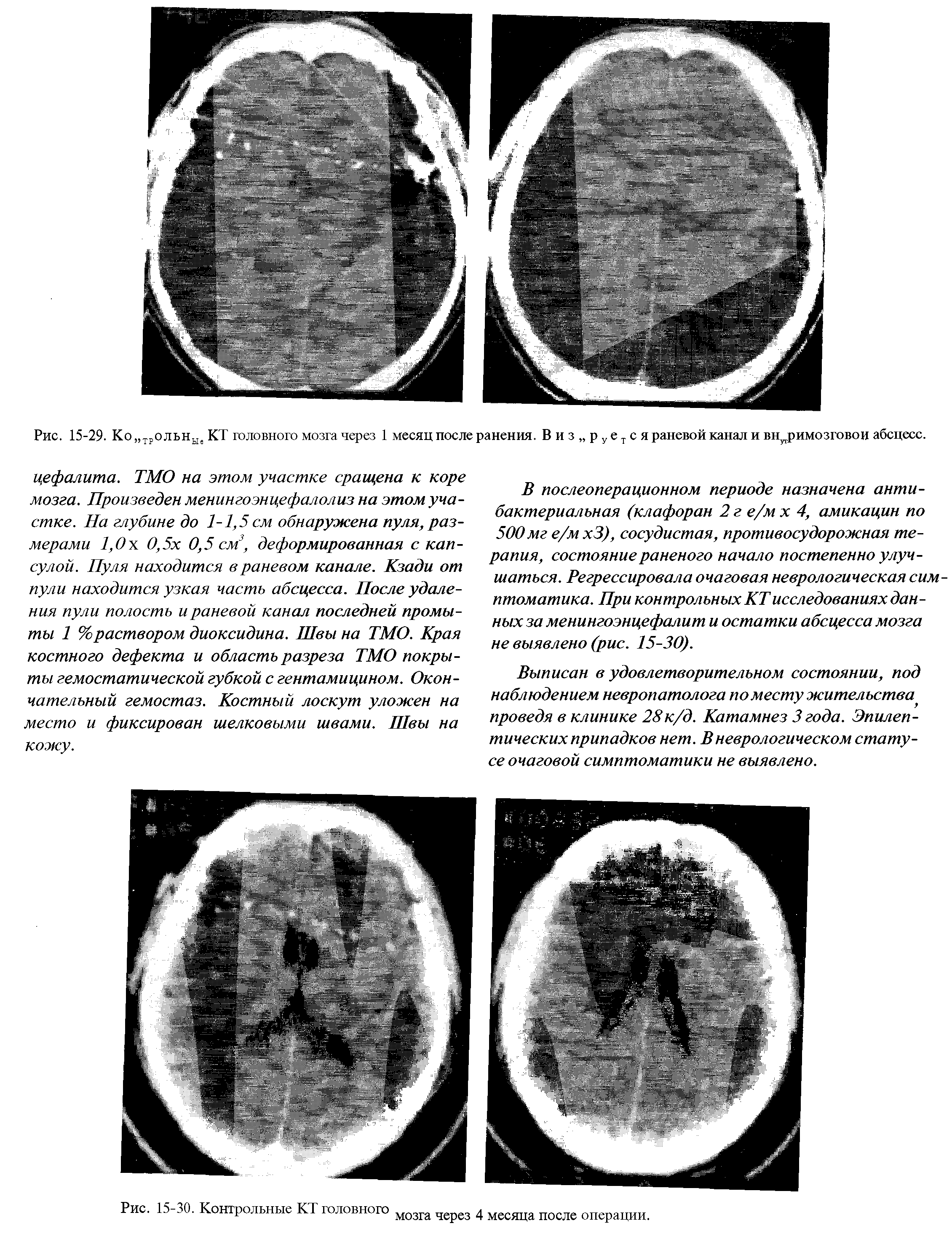 Рис. 15-29. Ко трольнЫе КТ головного мозга через 1 месяц после ранения. В и з р у е т с я раневой канал и вн римозговои абсцесс.