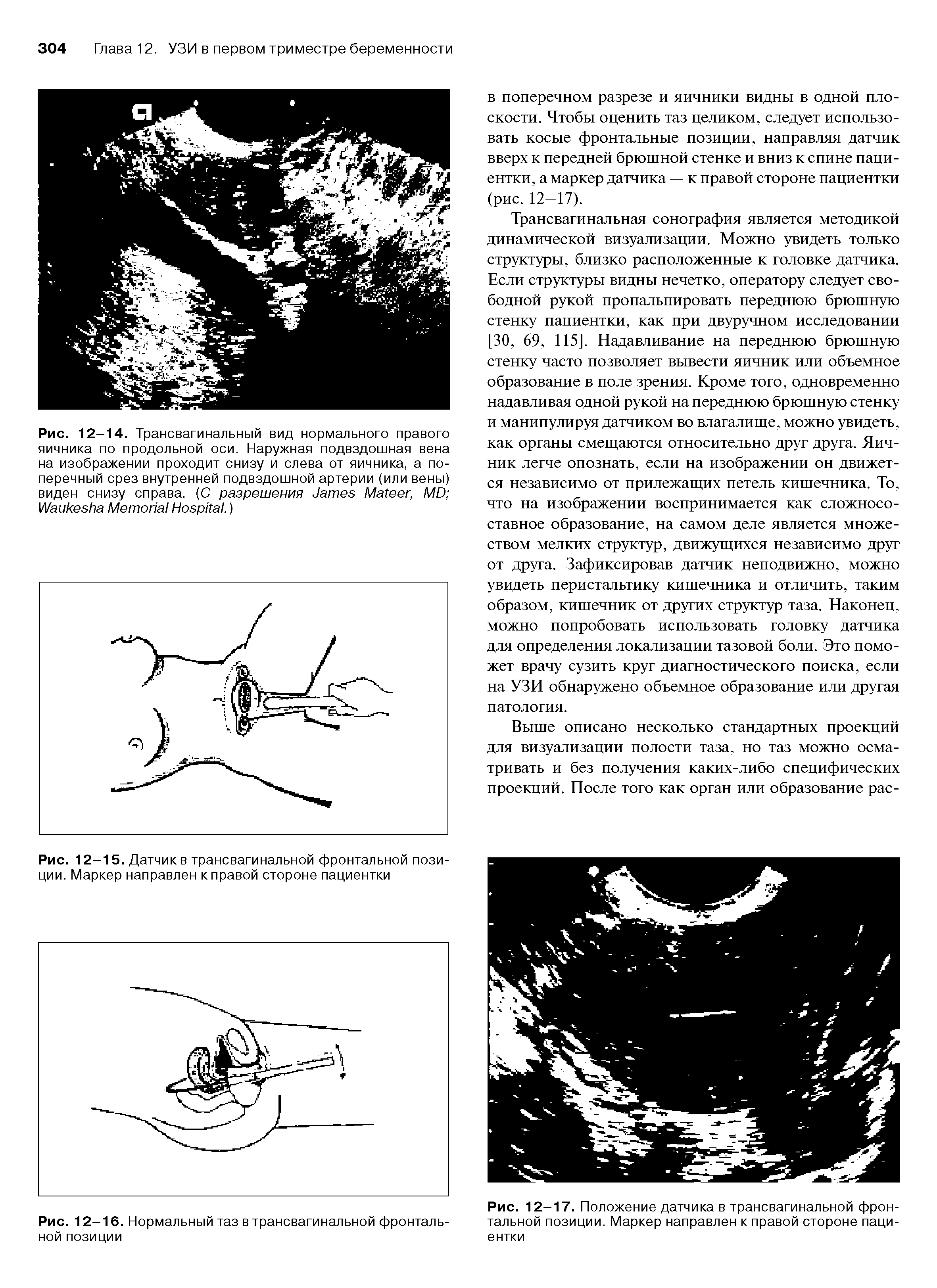 Рис. 12-15. Датчике трансвагинальной фронтальной позиции. Маркер направлен к правой стороне пациентки...