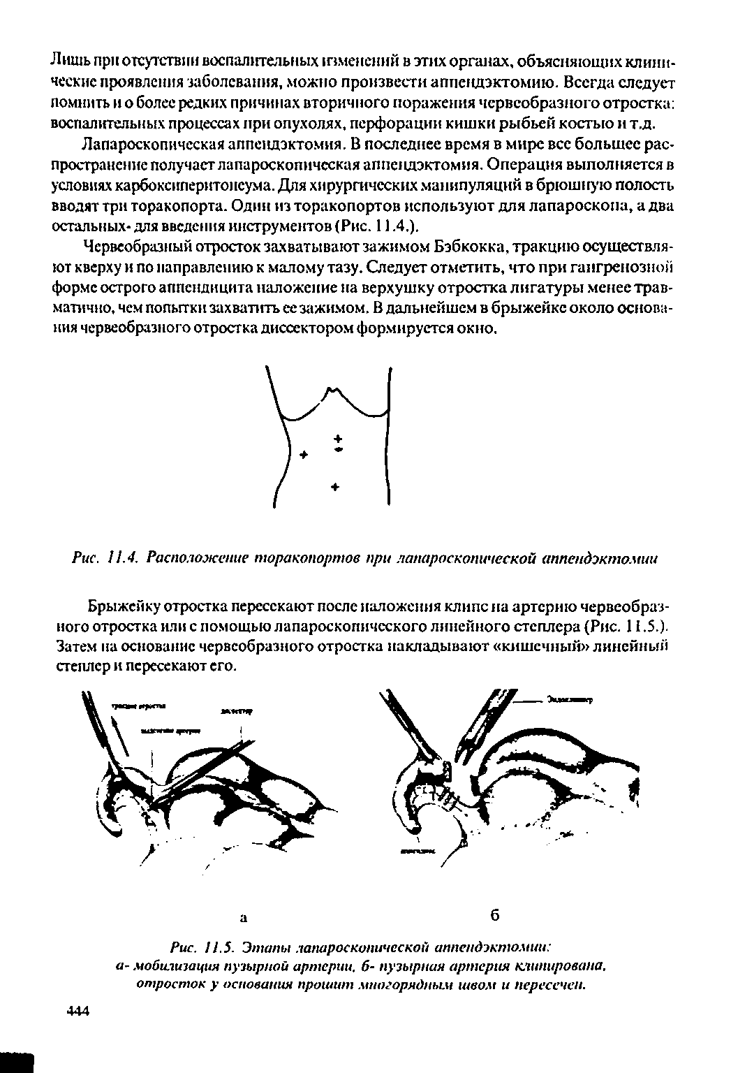Рис. 1.5. Этапы лапароскопической аппендэктомии а- мобилизация пузырной артерии. 6- пузырная артерия клипирована, отросток у основания прошит миогорядным швом и пересечен.