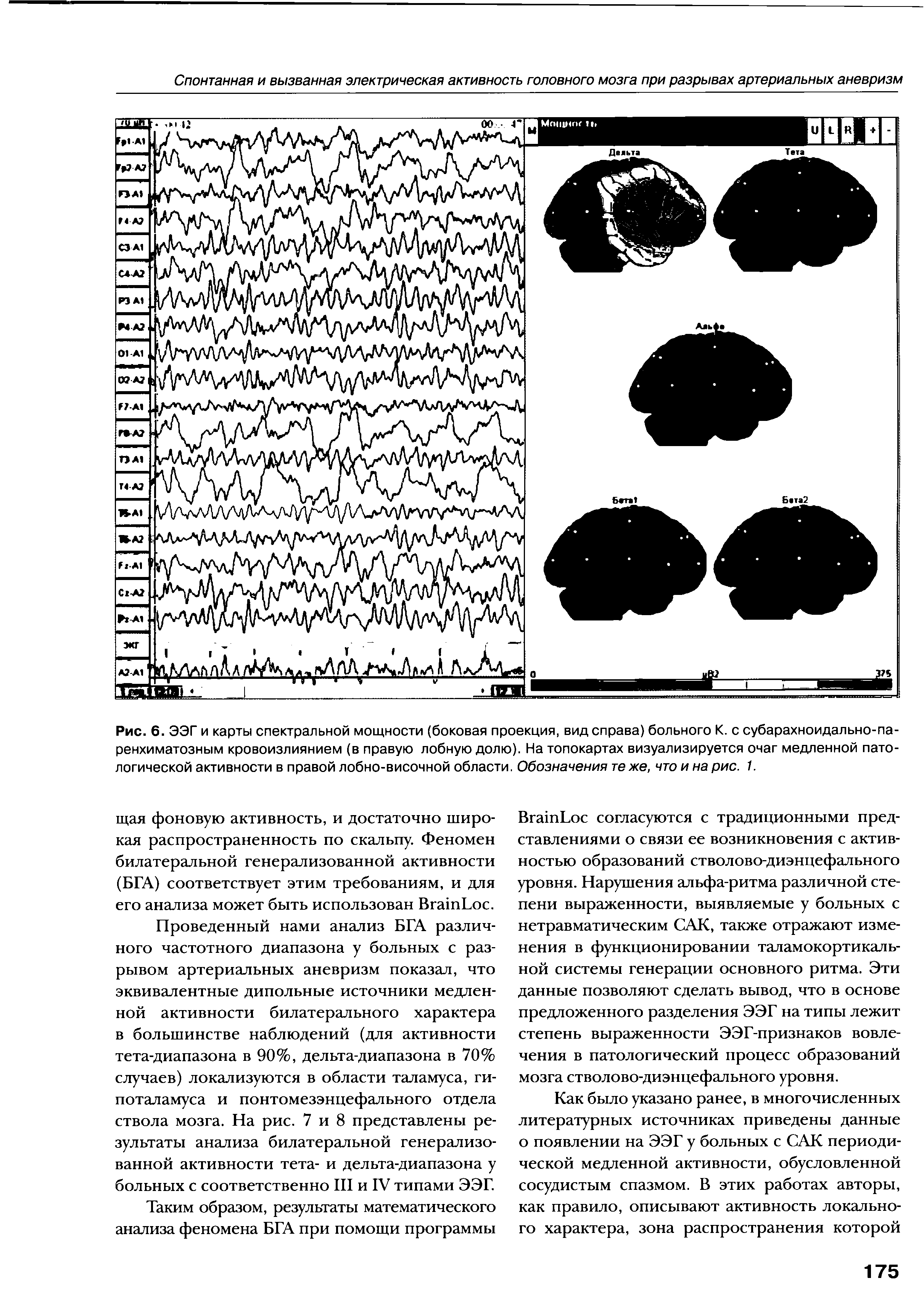 Рис. 6. ЭЭГ и карты спектральной мощности (боковая проекция, вид справа) больного К. с субарахноидально-паренхиматозным кровоизлиянием (в правую лобную долю). Натопокартах визуализируется очаг медленной патологической активности в правой лобно-височной области. Обозначения те же, что и на рис. 1.