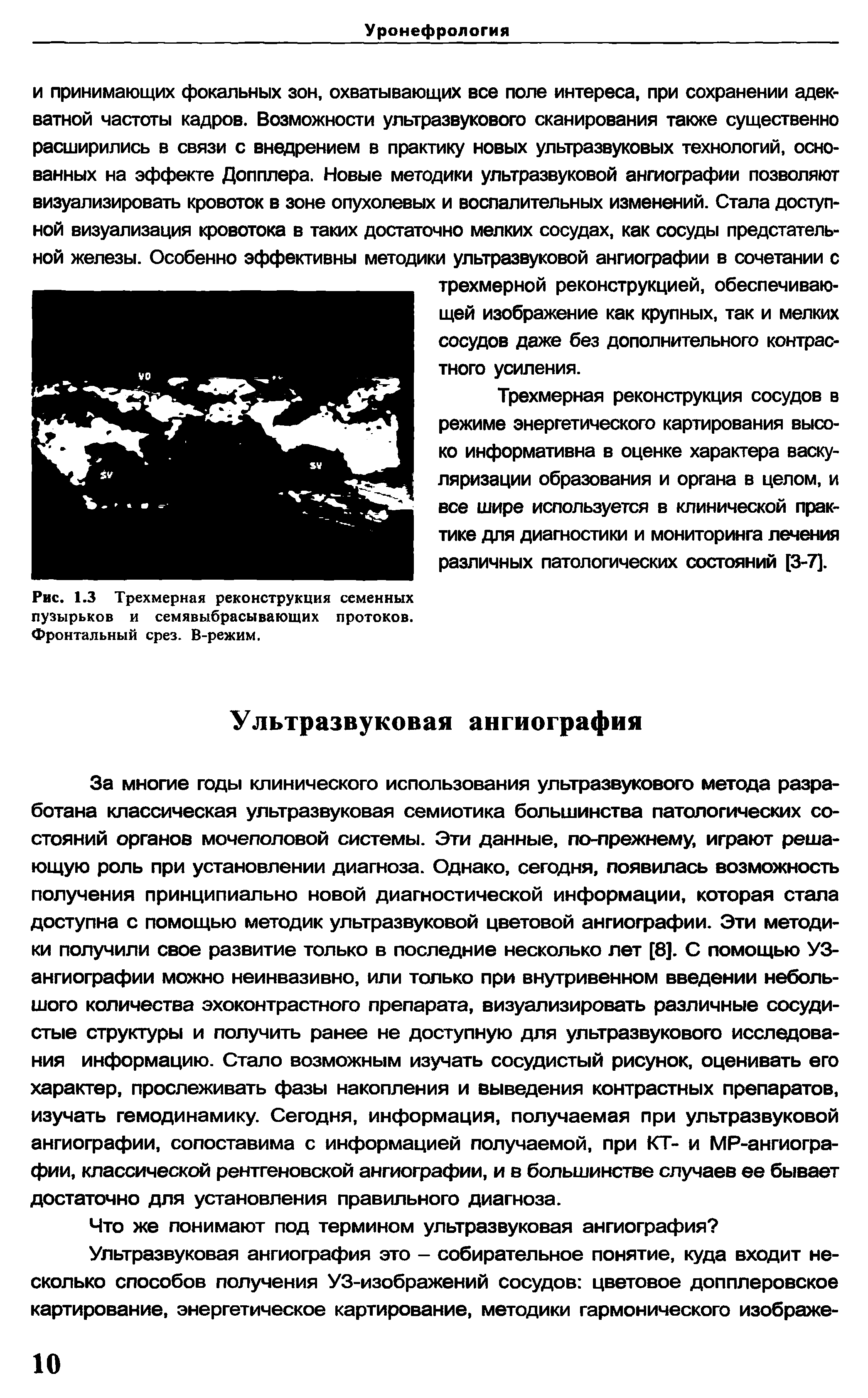 Рис. 1.3 Трехмерная реконструкция семенных пузырьков и семявыбрасывающих протоков. Фронтальный срез. В-режим.