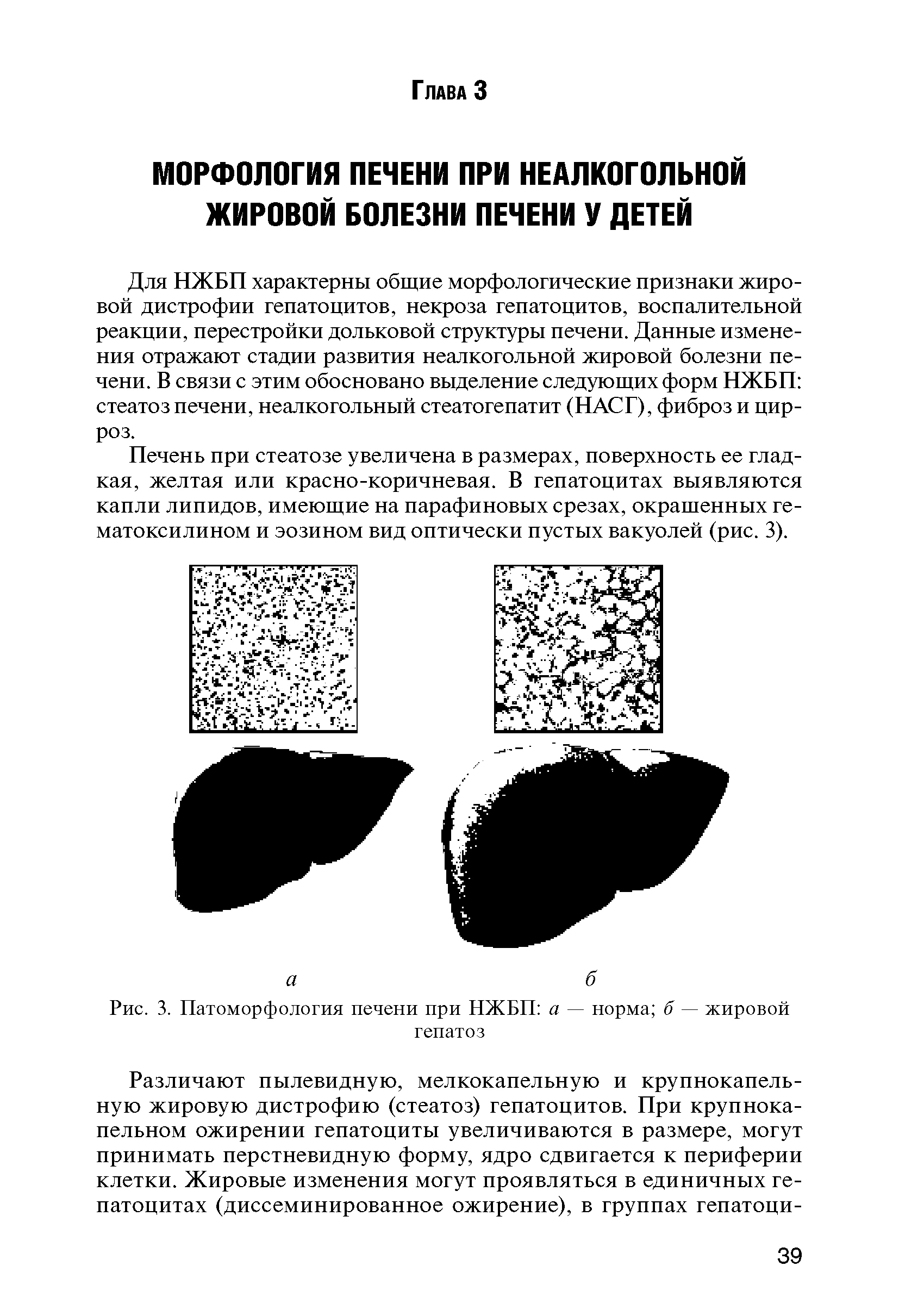 Рис. 3. Патоморфология печени при НЖБП а — норма б — жировой гепатоз...