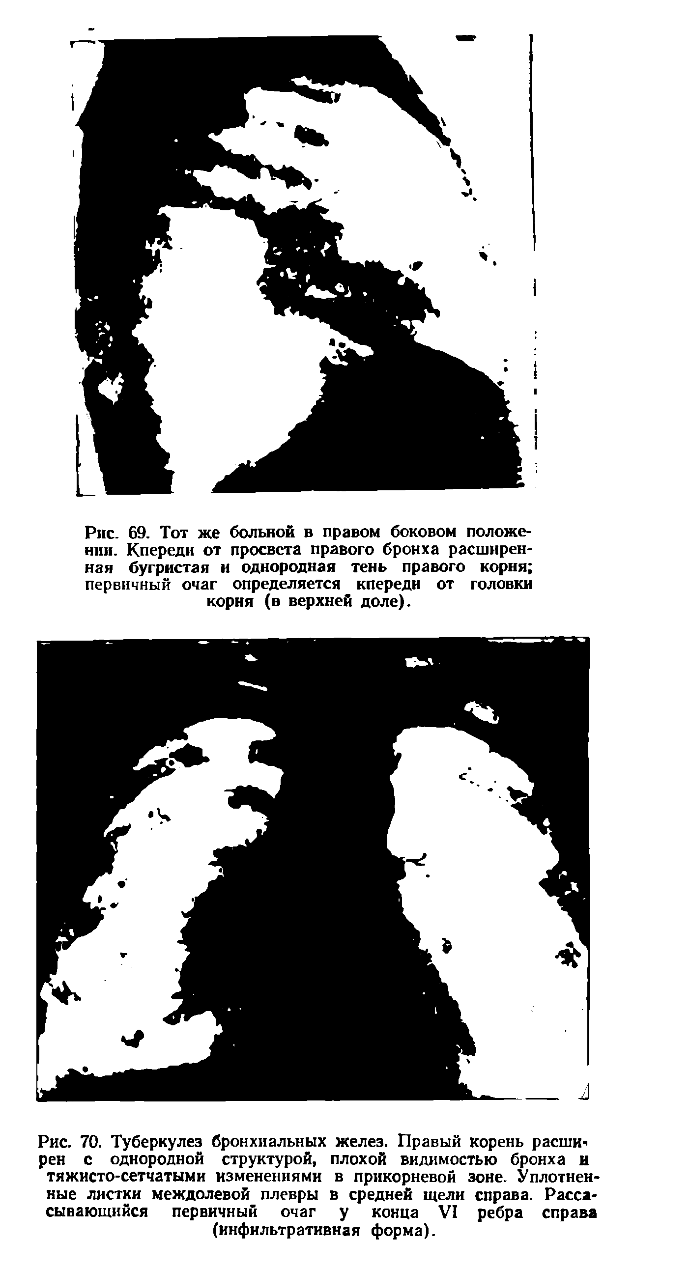 Рис. 69. Тот же больной в правом боковом положении. Кпереди от просвета правого бронха расширенная бугристая и однородная тень правого корня первичный очаг определяется кпереди от головки корня (в верхней доле).