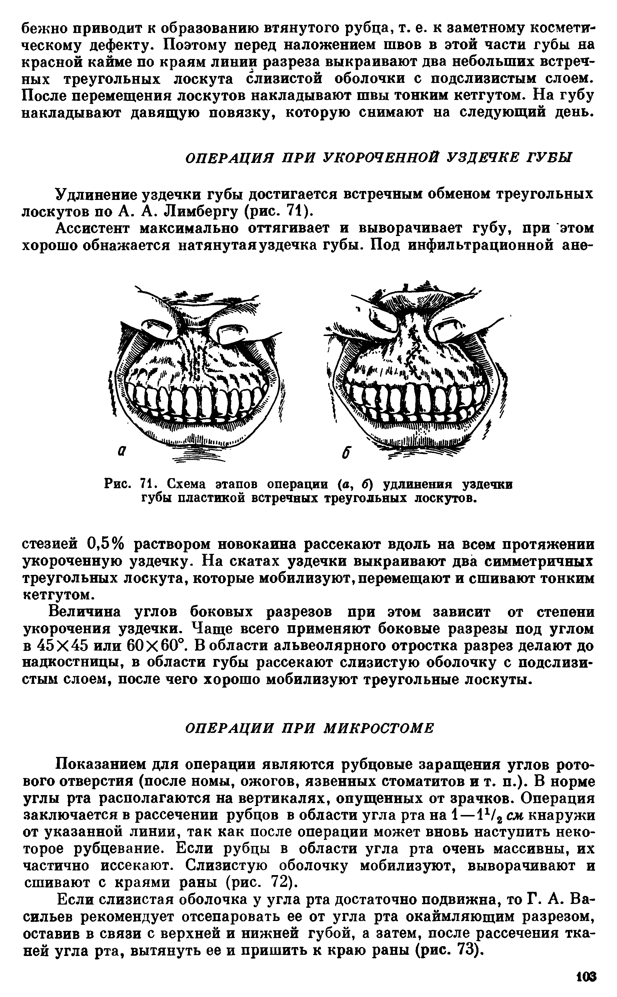 Рис. 71. Схема этапов операции (а, б) удлинения уздечки губы пластикой встречных треугольных лоскутов.