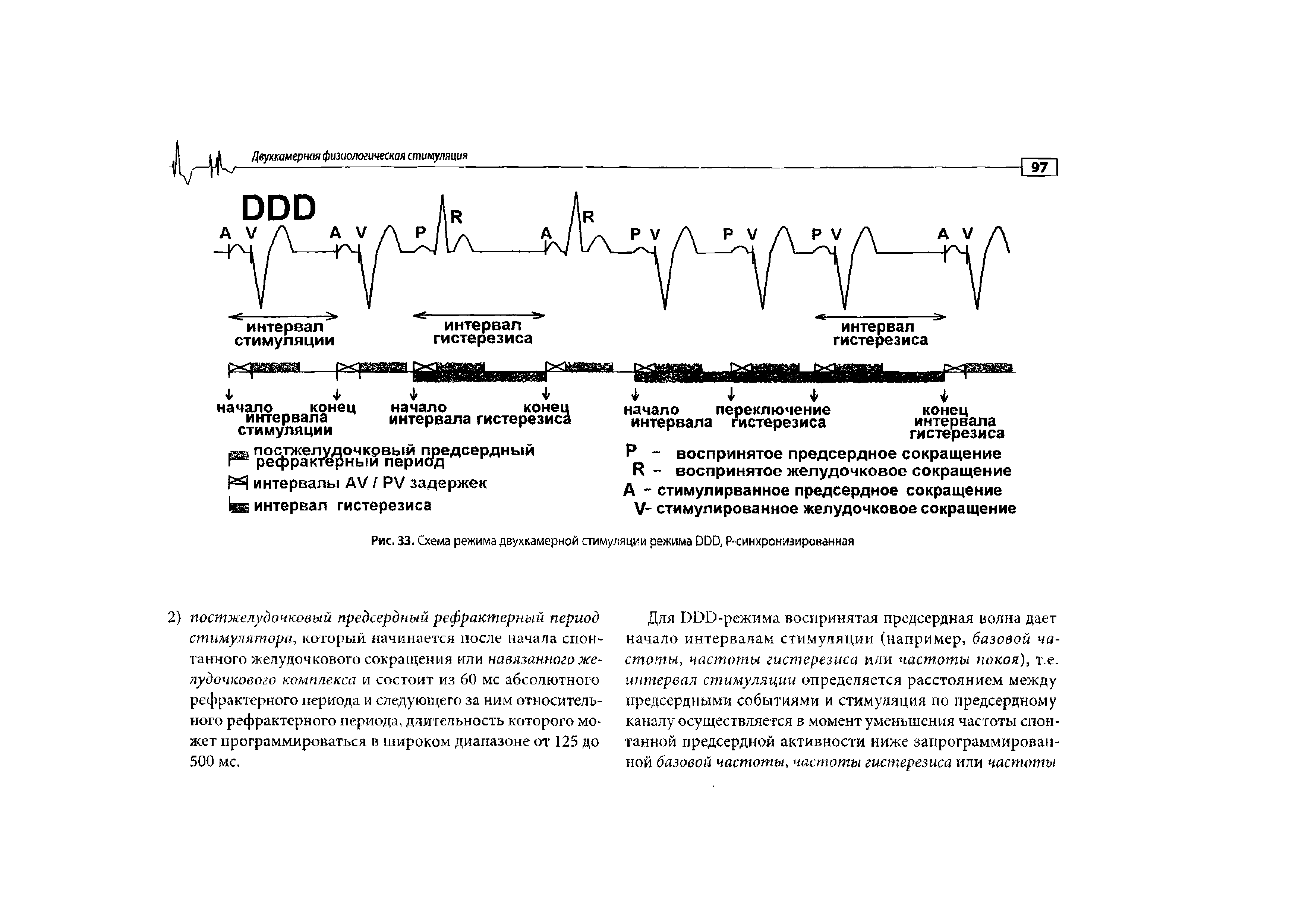 Рис. 33. Схема режима двухкамерной стимуляции режима DDD, Р-синхронизированная...