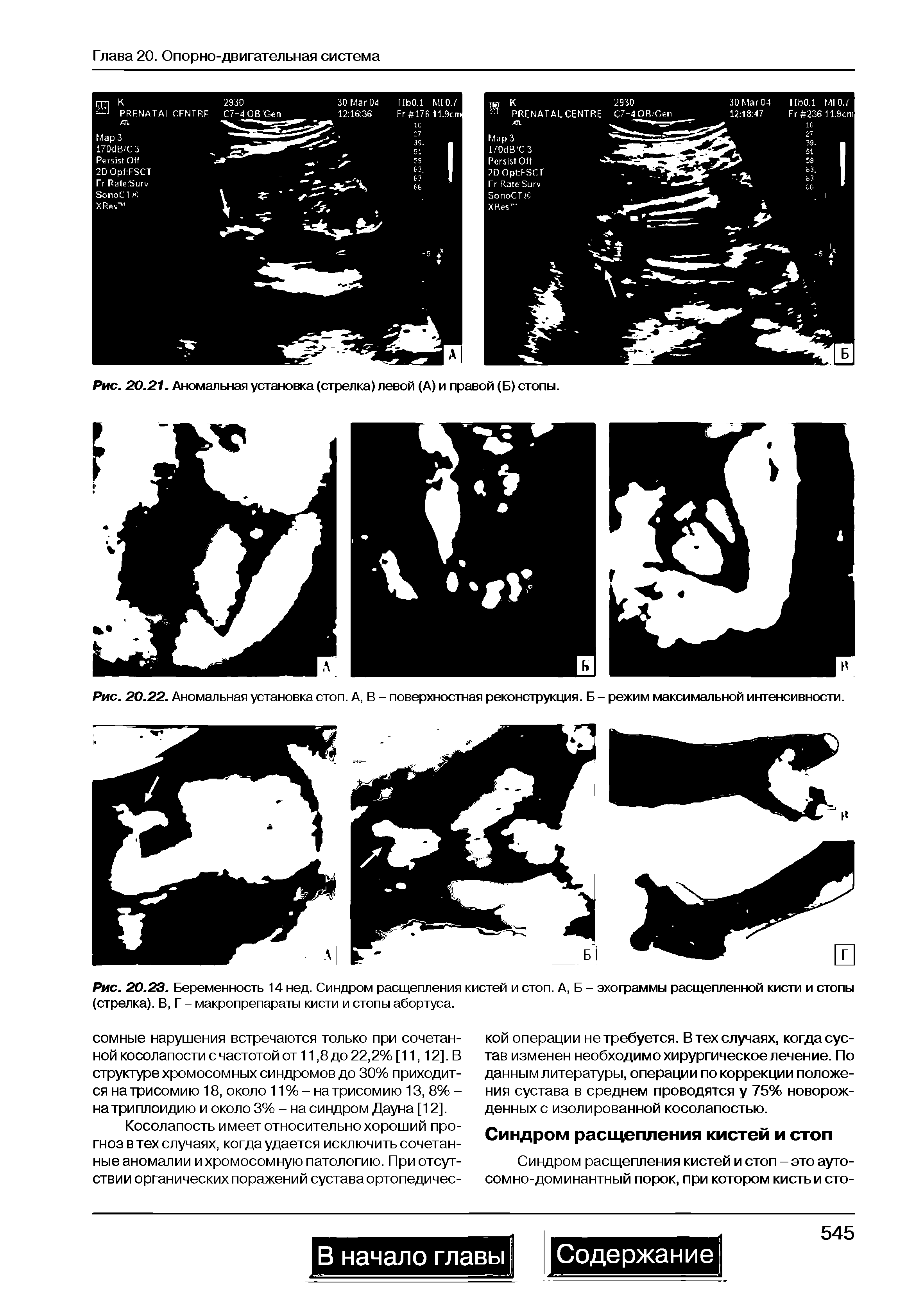 Рис. 20.23. Беременность 14 нед. Синдром расщепления кистей и стоп. А, Б - эхограммы расщепленной кисти и стопы (стрелка). В, Г - макропрепараты кисти и стопы абортуса.