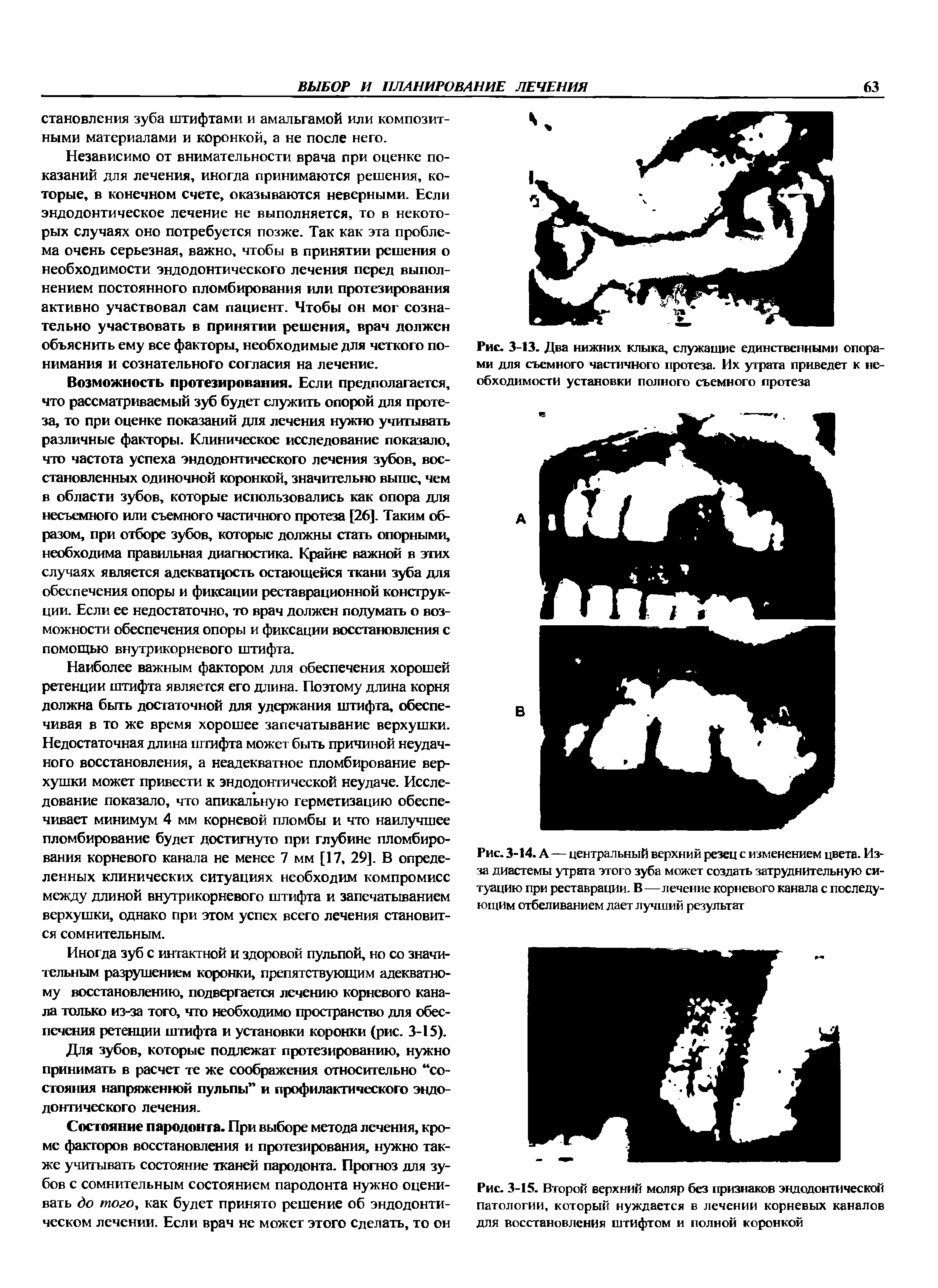 Рис. 3-14. А — центральный верхний резец с изменением цвета. Из-за диастемы утрата этого зуба может создать затруднительную ситуацию при реставрации. В—лечение корневого канала с последующим отбеливанием дает лучший результат...