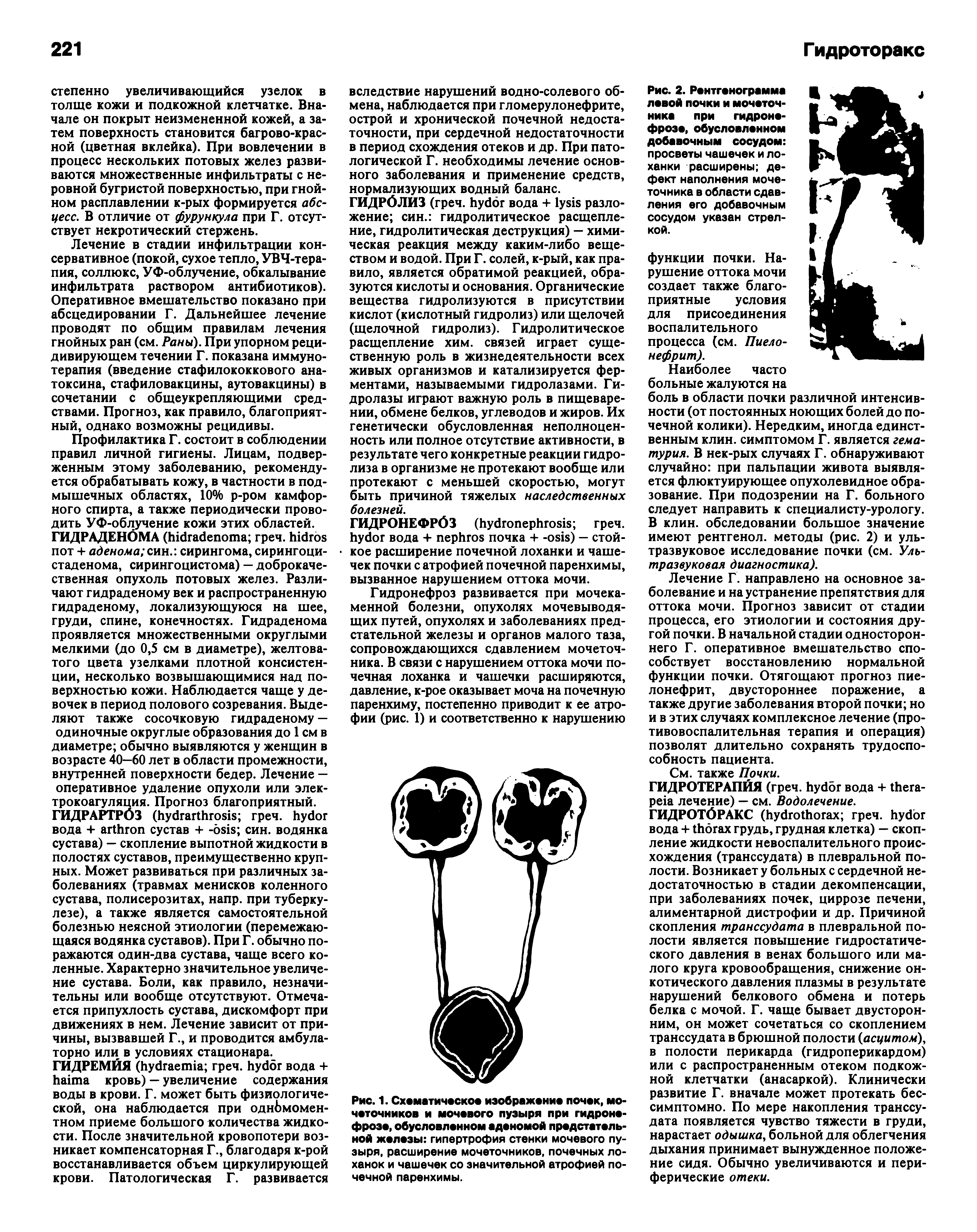 Рис. 1. Схематическое изображение почек, мочеточников и мочевого пузыря при гидронефрозе, обусловленном аденомой предстательной железы гипертрофия стенки мочевого пузыря, расширение мочеточников, почечных лоханок и чашечек со значительной атрофией почечной паренхимы.