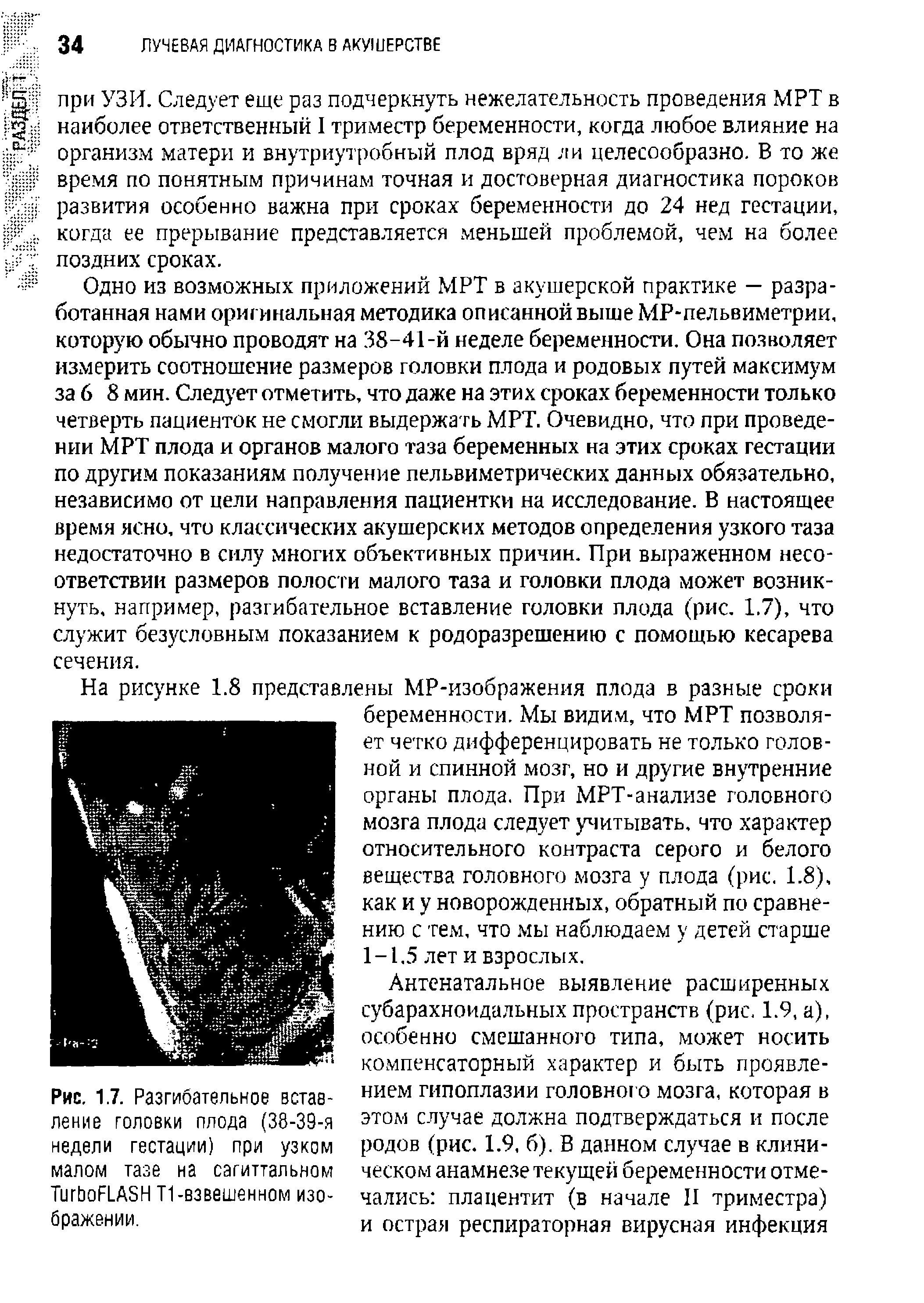 Рис. 1.7. Разгибательное вставление головки плода (38-39-я недели гестации) при узком малом тазе на сагиттальном ТигЬоГ1 А5Н Т1-взвешенном изображении.