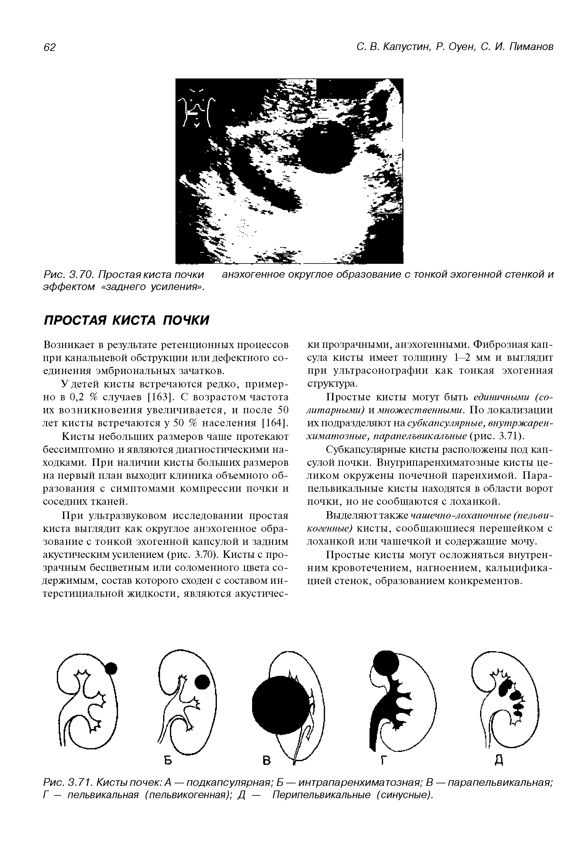 Рис. 3.71. Кисты почек А — подкапсулярная Б — интрапаренхиматозная В — парапельвикальная Г — пельвикальная (пельвикогенная) Д — Перипельвикальные (синусные).