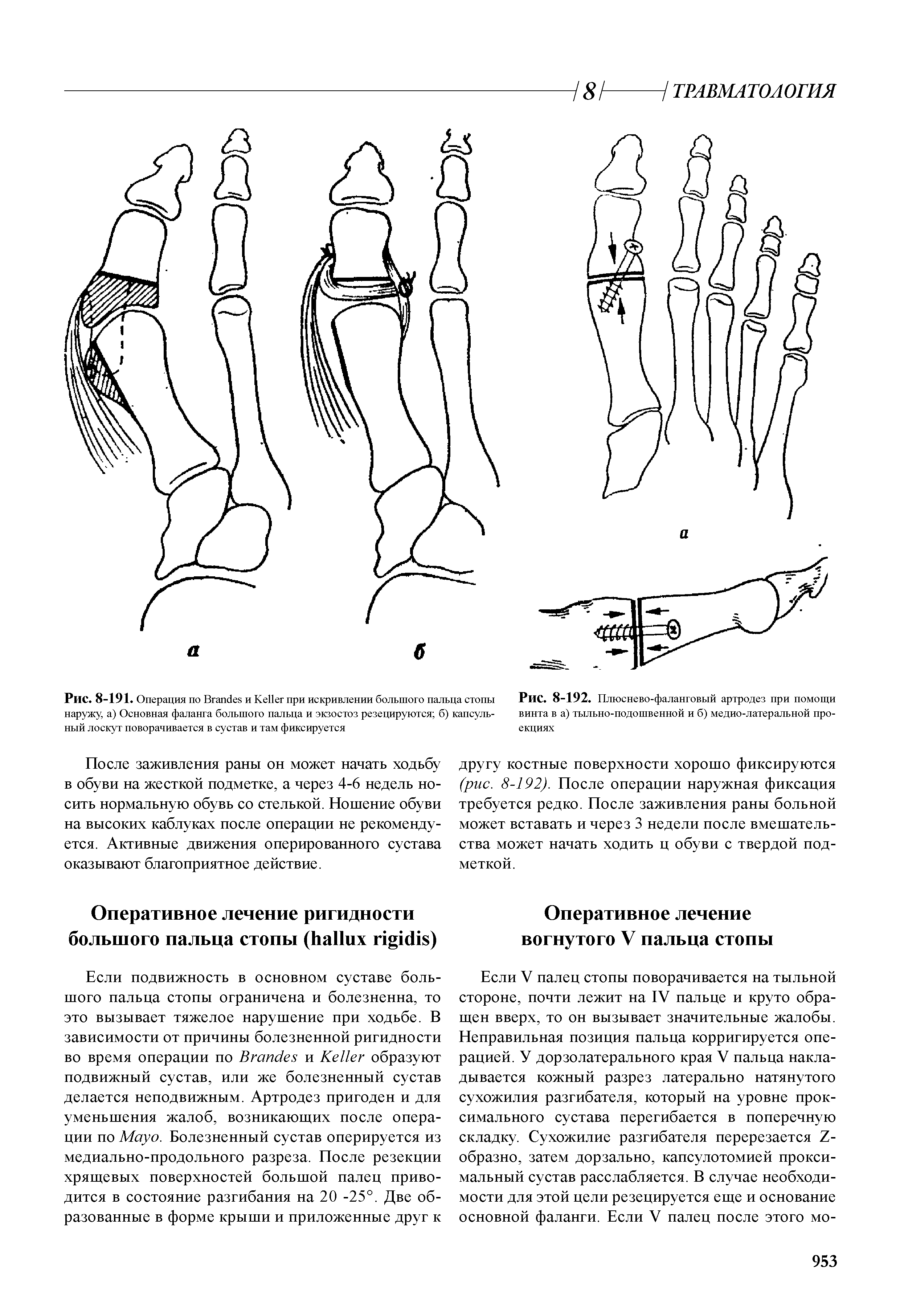 Рис. 8-191. Операция по B и K при искривлении большого пальца стопы наружу, а) Основная фаланга большого пальца и экзостоз резецируются б) капсульный лоскут поворачивается в сустав и там фиксируется...