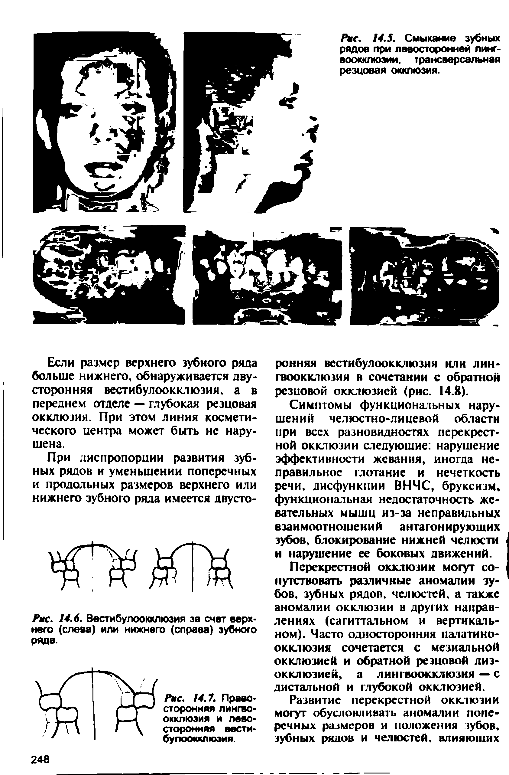 Рис. 14.6. Вестибулоокклюзия за счет верхнего (слева) или нижнего (справа) зубного ряда.