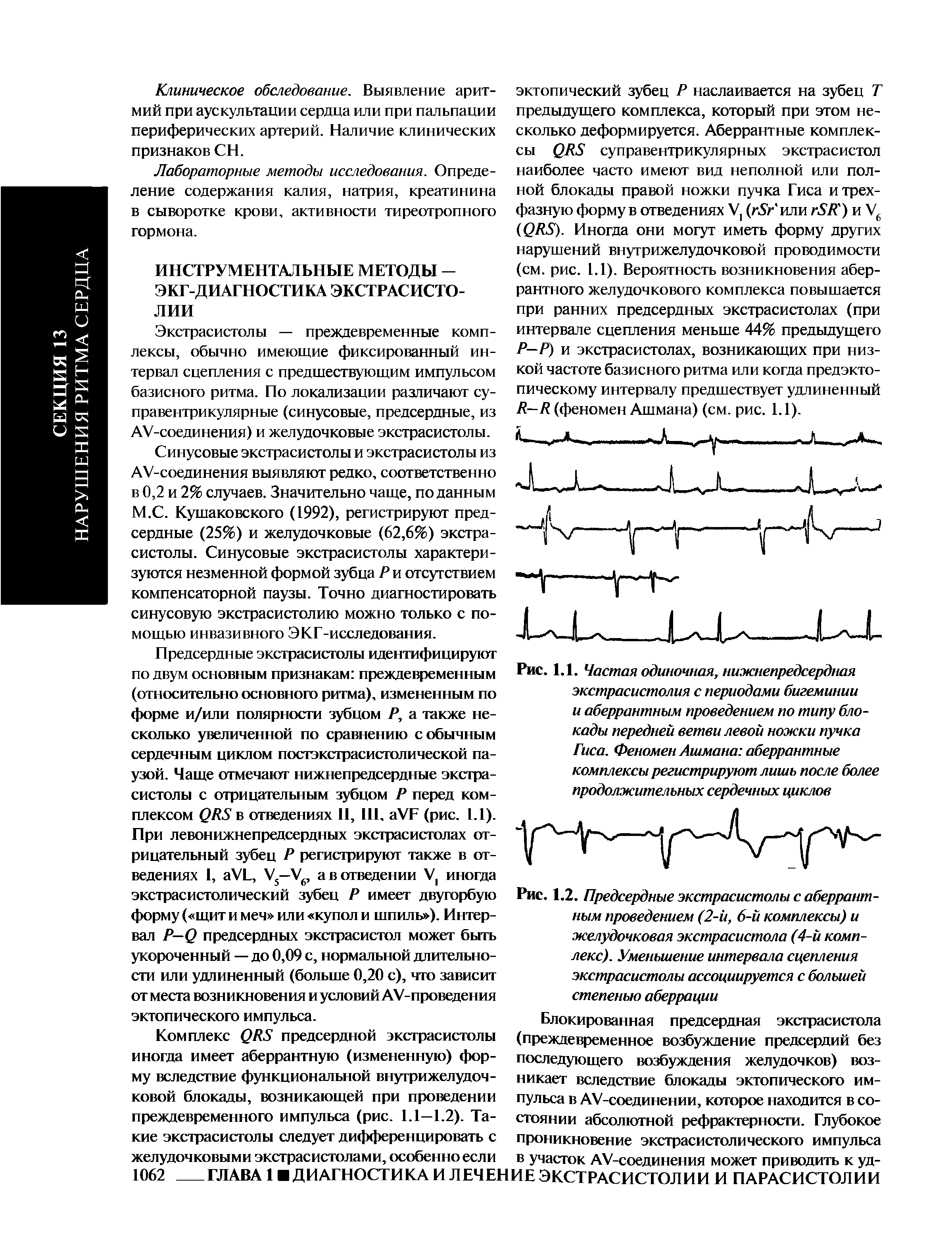 Рис. 1.2. Предсердные экстрасистолы с аберрантным проведением (2-й, 6-й комплексы) и желудочковая экстрасистола (4-й комплекс). Уменьшение интервала сцепления экстрасистолы ассоциируется с большей степенью аберрации...