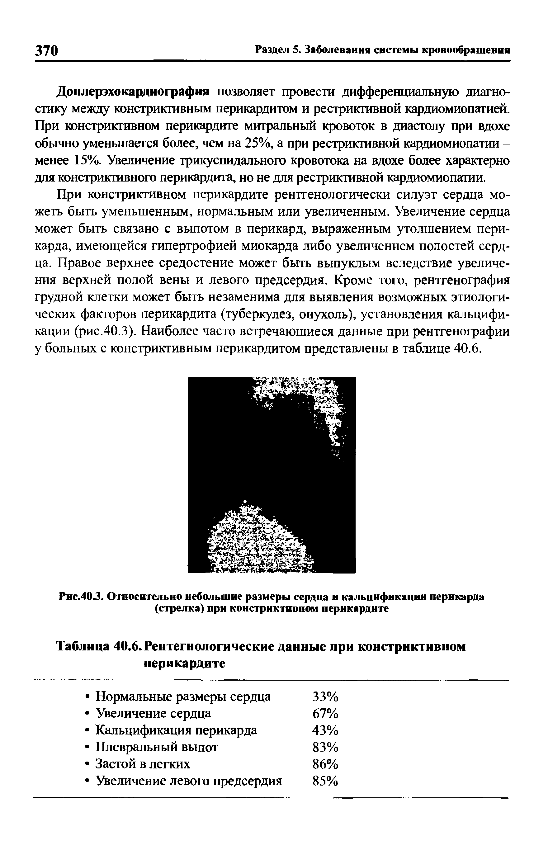 Рис.40.3. Относительно небольшие размеры сердца и кальцификации перикарда (стрелка) при констриктивном перикардите...