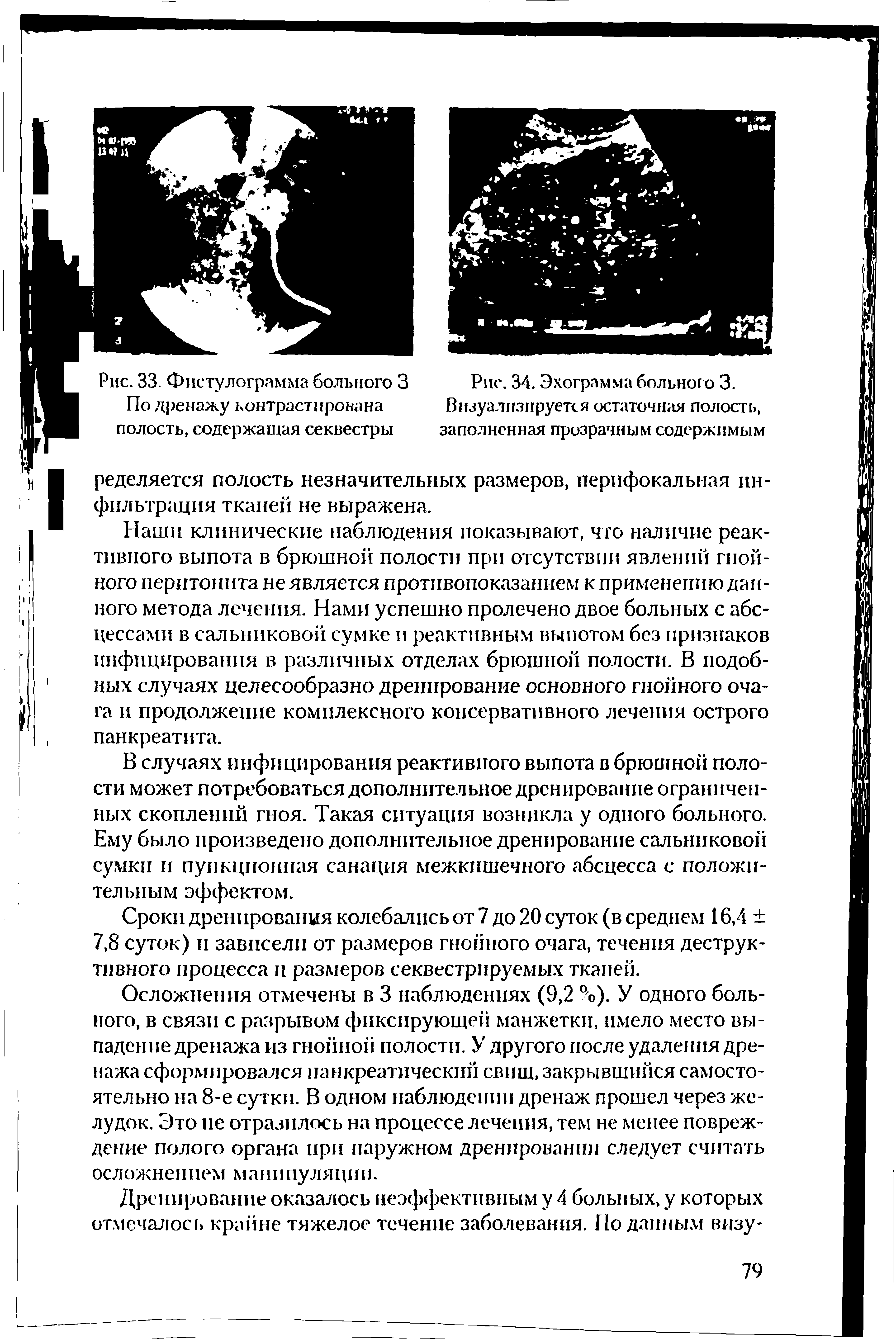 Рис. 34. Эхограмма больного 3. Визуализируется остаточная полость, заполненная прозрачным содержимым...