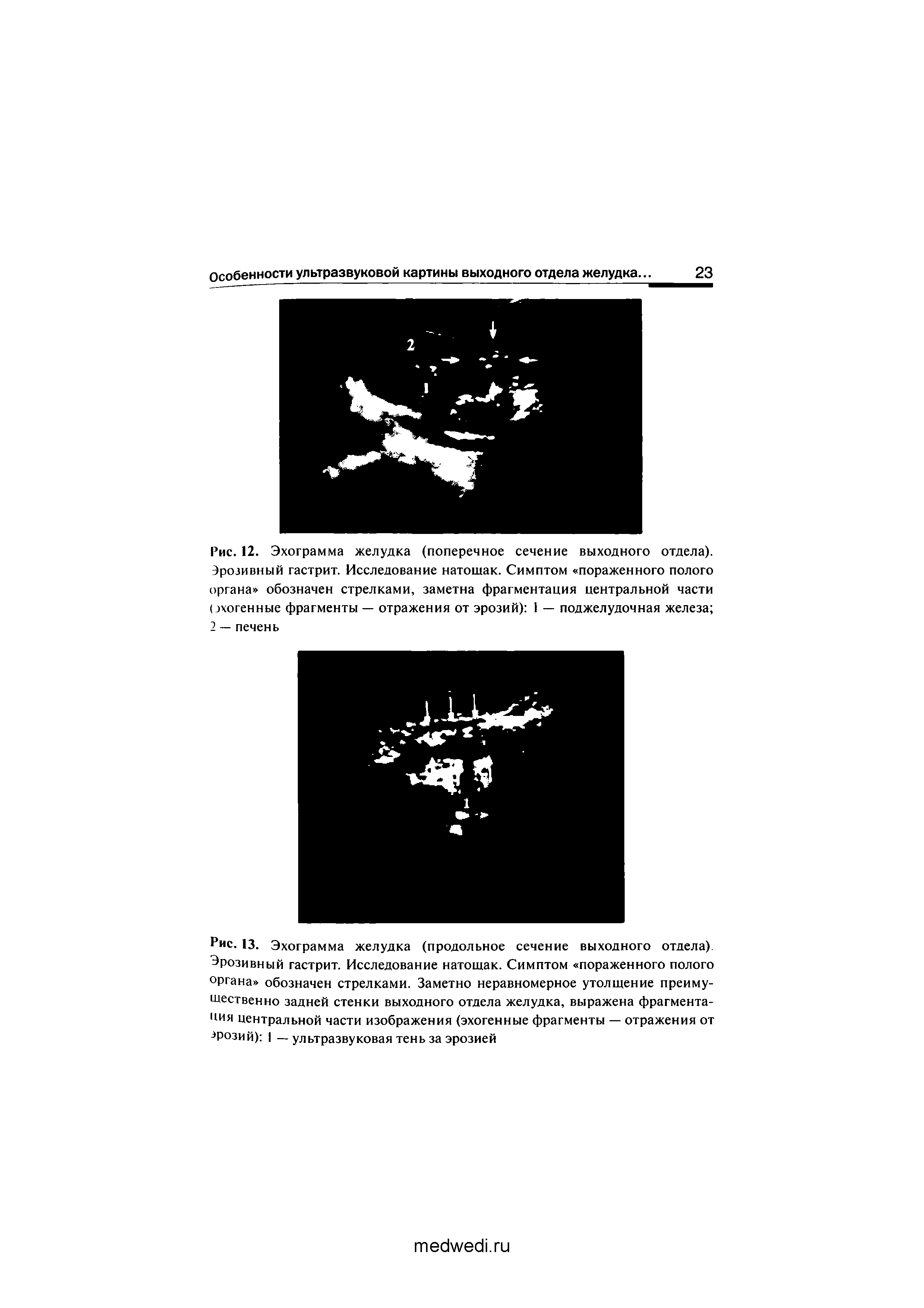 Рис. 12. Эхограмма желудка (поперечное сечение выходного отдела). Эрозивный гастрит. Исследование натошак. Симптом пораженного полого органа обозначен стрелками, заметна фрагментация центральной части (эхогенные фрагменты — отражения от эрозий) 1 — поджелудочная железа 2 — печень...