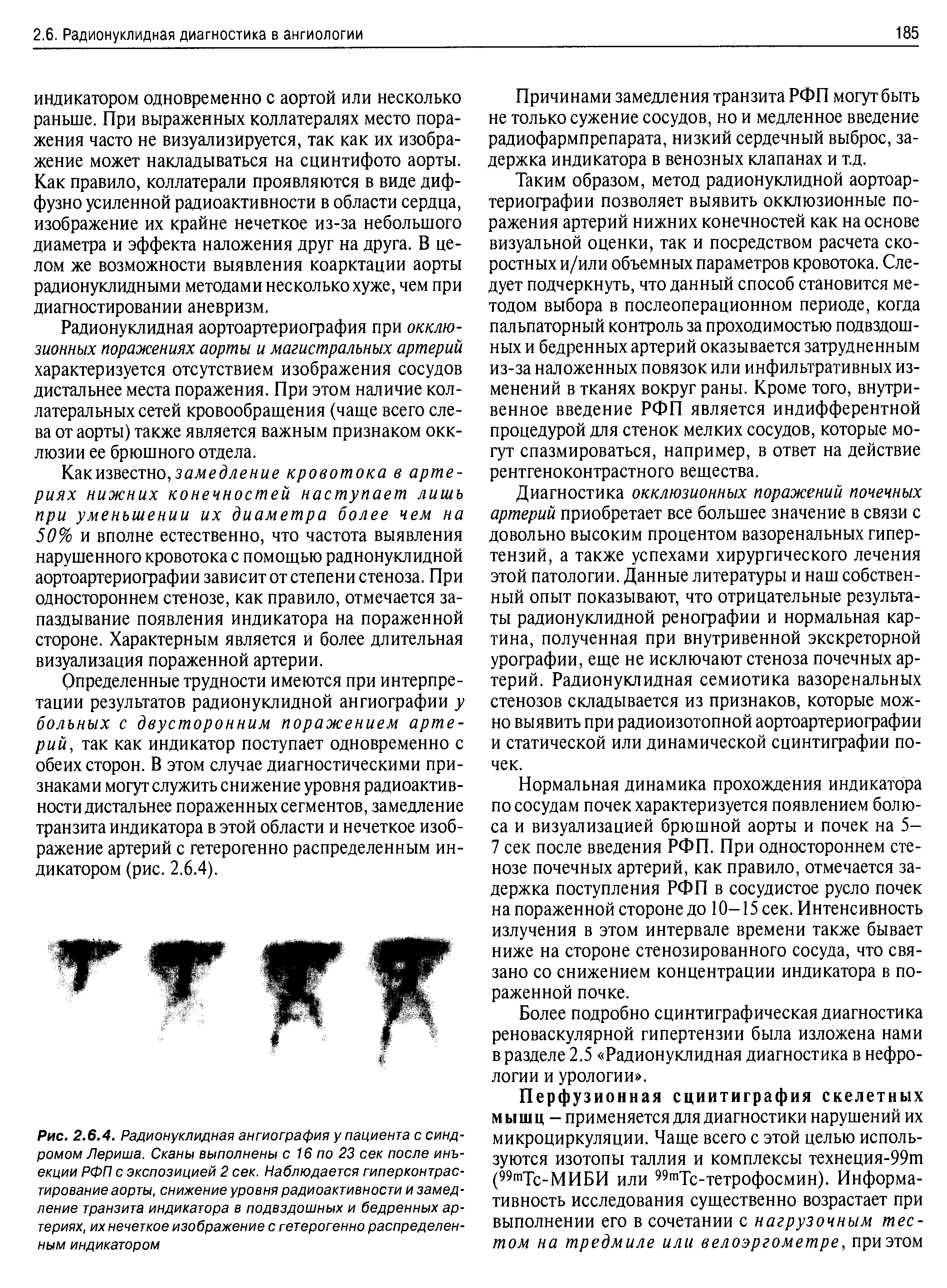 Рис. 2.6.4. Радионуклидная ангиография у пациента с синдромом Лериша. Сканы выполнены с 16 по 23 сек после инъекции РФП с экспозицией 2 сек. Наблюдается гиперконтрастирование аорты, снижение уровня радиоактивности и замедление транзита индикатора в подвздошных и бедренных артериях, их нечеткое изображение с гетерогенно распределенным индикатором...