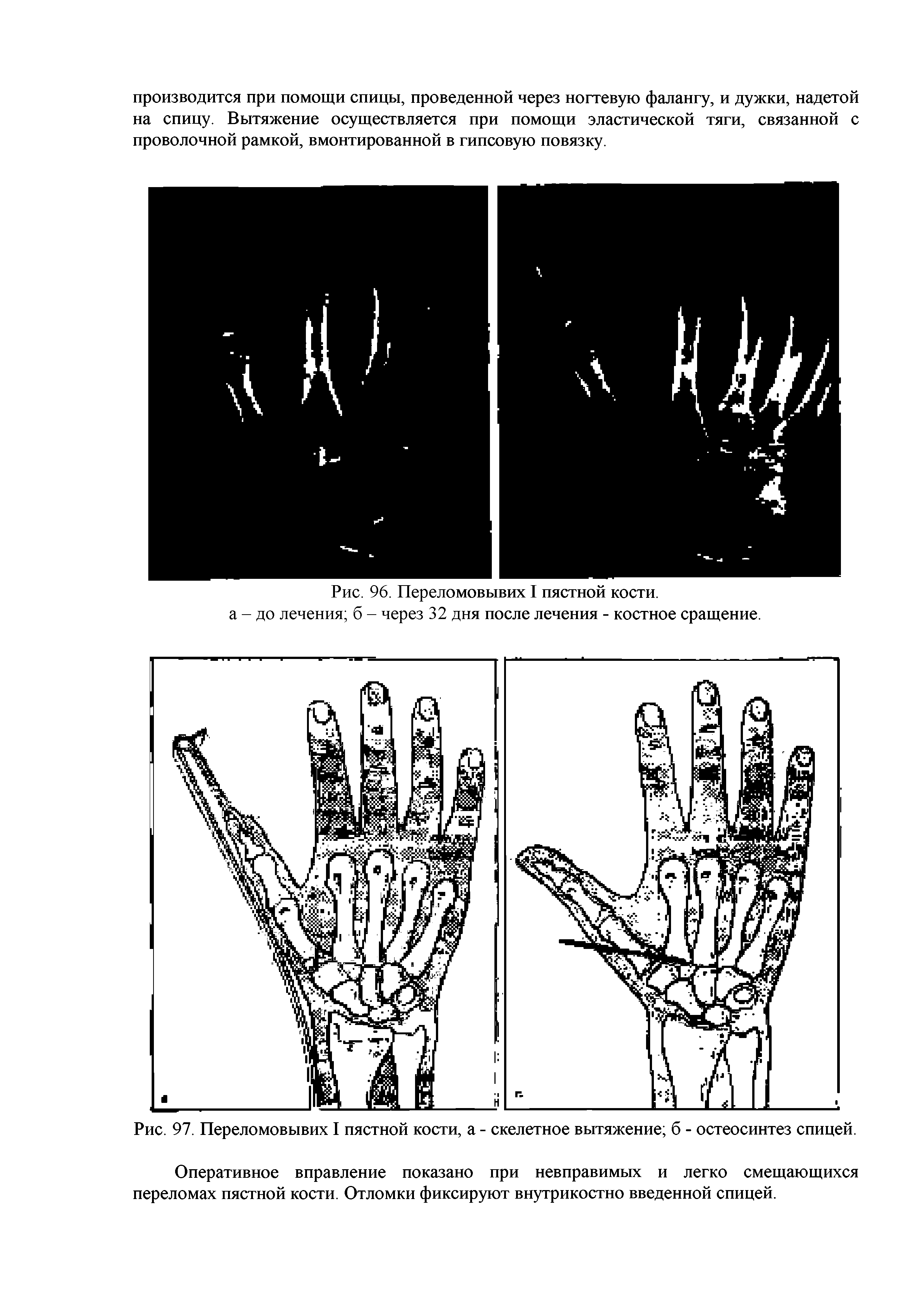 Рис. 97. Переломовывих I пястной кости, а - скелетное вытяжение б - остеосинтез спицей.